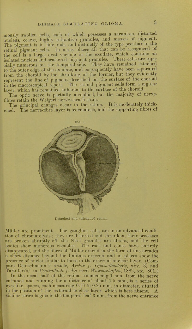 mously swollen cells, each of which possesses a shrunken, distorted nucleus, coarse, highly refractive granules, and masses of pigment. The pigment is in fine rods, and distinctly of the type peculiar to the retinal pigment cells. In many places all that can be recognized of the cell is a large, oval vacuole in the exudate, which contains an isolated nucleus and scattered pigment granules. These pells are espe- cially numerous on the temporal side. They have remained attached to the outer edge of the exudate, and consequently have been separated from the choroid by the shrinking of the former, but they evidently represent the line of pigment described on the surface of the choroid in the macroscopical report. The retinal pigment cells form a regular layer, which has remained adherent to the surface of the choroid. The optic nerve is partially atrophied, but the majority of nerve- fibres retain the Weigert nerve-sheath stain. The principal changes occur in the retina. It is moderately thick- ened. The nerve-fibre layer is (Edematous, and the supporting fibres of Fig. Detached and thickened retina. Miiller are prominent. The ganglion cells are in an advanced condi- tion of chromatolysis; they are distorted and shrunken, their processes are broken abrii[)tly off, the Nissl granules are absent, and the cell bodies show numerous vacuoles. The rods and cones have entirely disappeared, and the fibres of Miiller extend in the form of fine arcades a short distance beyond the limitans externa, and in places show the presence of nuclei similar to those in the external nuclear layer. (Com- pare Deutschmann's' article, Arckiv f. Ophtlialmolorjie, xxv. 3, and Tartuferi's,'' in Centralblalt /. die med. Wissenscliaften, 1882, xx. 801.) In the nasal half of the retina, commencing 1 mm. from the nerve entrance and running for a distance of about 1.5 mm., is a series of cyst-like spaces, each measuring O.IG to 0.25 mm. in diameter, situated in the position of the external nuclear layer, which is here absent. A similar series begins in the temporal leaf 3 mm. from the nerve entrance