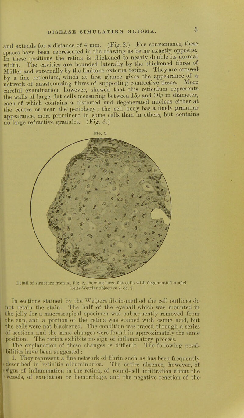 5- and extends for a distance of 4 mm. (Fig. 2.) For convenience, these spaces have been represented in the drawing as being exactly opposite. In these positions the retina is thickened to nearly double its normal width. The cavities are bounded laterally by the thickened fibres of M filler and externally by the limitaus externa retinas. They are crossed by a fine reticulum, which at first glance gives the appearance of a network of anastomosing fibres of supporting connective tissue. More careful examination, however, showed that this reticuluni represents the walls of large, flat cells measuring between 15/t and 30/^ in diameter, each of which contains a distorted and degenerated nucleus either at the centre or near the periphery; the cell body has a finely granular appearance, more prominent in some cells than in others, but contains no large refractive granules. (Fig. 3.) Fig. 3. DetaU of structure from A, Fii;. 2, showing Uw^c Hat cells with degenerated nuclei Leilz-Wetzlar objective 7, oc. 3. In sections stained by the Weigert fibrin-method the cell outlines do- not retain the stain. The half of the eyeball which was mounted in the jelly for a macroscopical specimen was subsequently removed from the cup, and a portion of the retina was ftained with osmic acid, but the cells were not blackened. The condition Avas traced through a series of sections, and the same changes were found in approximately the same position. The retina exhibits no sign of inflammatory process. The explanation of these changes is difficult. The following possi- bilities have been suggested : 1. They represent a fine network of fibrin such as has been frequently I described in retinitis albuminurica. The entire absence, however, of 5signs of inflammation in the retina, of round-cell infiltration about the 'Vessels, of exudation or hemorrhage, and the negative reaction of the