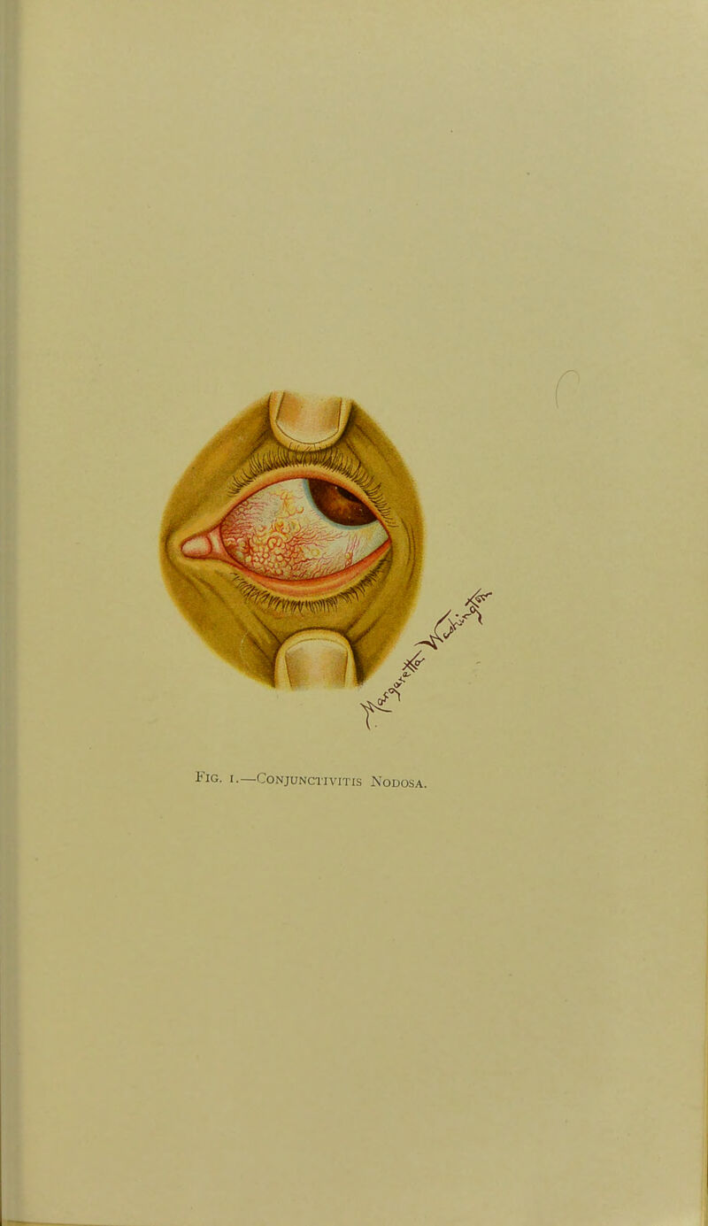 Fig. I.—Conjunctivitis Nodosa.