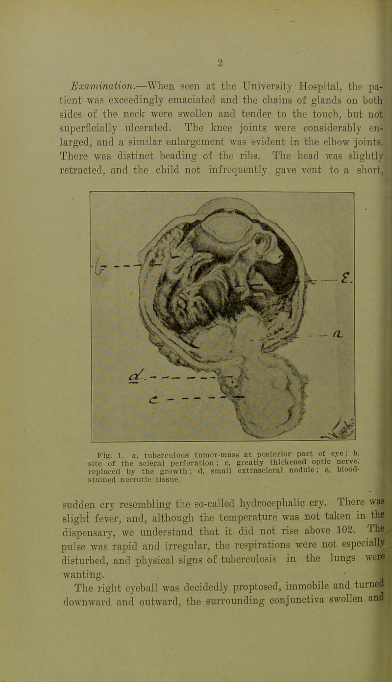 Examination.—When seen at the University Hospital, the pa- tient was exceedingly emaciated and the chains of glands on both sides of the neck were swollen and tender to the touch, but not superficially ulcerated. The knee joints were considerably en- larged, and a similar enlargement was evident in the elbow joints. There was distinct beading of the ribs. The head was slight] retracted, and the child not infrequently gave vent to a sliort, Fig. ]. a, tubarculous tumor-mass at posterior part of eye; b, site of tlie sclerai perforation; c, greatly thiclcened optic nerve, replaced by the growth; d, small extrascleral nodule; e, blood- stained necrotic tissue. sudden cry resembling the so-called hydrocephalic cry. There was slight fever, and, although the temperature was not taken in the dispensary, we understand that it did not rise above 102. The pulse was rapid and irregular, the respirations were not especially disturbed, and physical signs of tuberculosis in the lungs were wanting. The right eyeball was decidedly proptosed, immobile and turned downward and outward, the surrounding conjunctiva swollen and