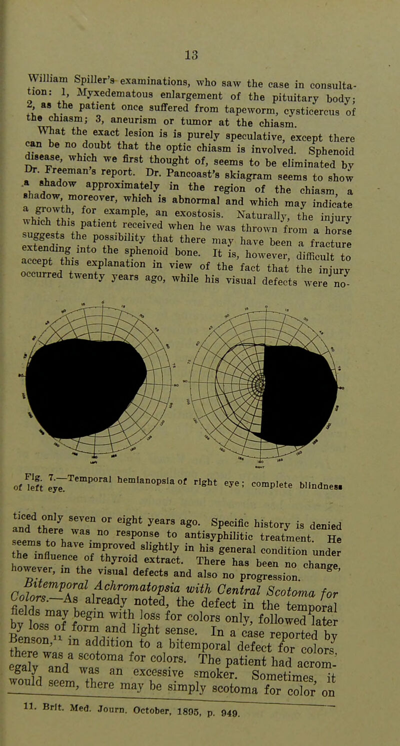 William Spiller'9 examinations, who saw the case in consulta- tion: 1, Myxedematous enlargement of the pituitary body: 2 as the patient once suffered from tapeworm, cysticercus of tie chiasm; 3, aneurism or tumor at the chiasm mat the exact lesion is is purely speculative, except there can be no doubt that the optic chiasm is involved. Sphenoid disease, which we first thought of, seems to be eliminated by Dr. Freeman 8 report. Dr. Pancoast's skiagram seems to show «hadot approximately in the region of the chiasm, a shadow moreover, which is abnormal and which may indicate ^^.^.^'P^^' an exostosis. Naturally, the injury nhich this patient received when he was thrown f^om a horse xfS. n't'Th^'^*/ ^^^ ^ f-'t- accept this explanation m view of the fact that the iniurv occurred twenty years ago, while his visual defects wei-e'no OfTeft lyT'^''^'''*' right eye: complete blindnes. ticed only seven or eight years ago. Specific history is denied seems to haTr-  v \ *° -t-ypl^it- treatment He seems to have improved slightly in his general condition under he influence of thyroid extract. There has been no chant however, in the visual defects and also no progression. ^ ' Colors.~A8 already noted, the defect in the temnoral fields may begm with loss for colors only, folWedkter lienson, m addition to a bitemporal defect for rolnr« Sy an/ ':tr' ''''''' PatieSVad aim: egaiy and was an excessive smoker. Sometimes it 11. Brit. Med. Journ. October, 1895, p. 949. ~
