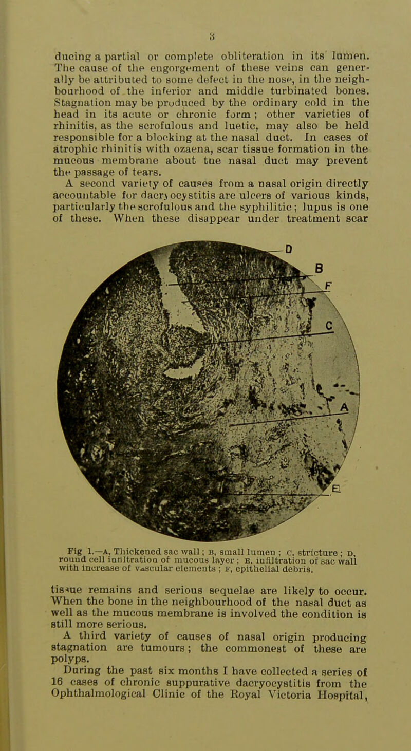 ducing a partial or complete obliteration in its lumen. The cause of the engorgement of these veins can gener- ally be attributed to some defect in the nose, in the neigh- bourhood of the inferior and middle turbinated bones. Stagnation may be produced by the ordinary cold in the head in its acute or chronic form ; other varieties of rhinitis, as the sci'ofulous and luetic, may also be held responsible for a blocking at the nasal duct. In cases of atrophic rhinitis with ozaena, scar tissue formation in the mucous membrane about tne nasal duct may prevent the passage of tears, A second variety of causes from a nasal origin directly accountable for dacr> ocystitis are ulcers of various kinds, parti<!ularly the scrofulous and the syphilitic; lupus is one of these. When these disappear under treatment scar Fig 1.—A, Tliickened sac wall; h, sinaU lumen ; c. stricture ; d, rouud cell iatiltration of mucous layer ; e. infiltratiou of sac wall with increase of vascular elements ; f, epithelial debris. tissue remains and serious sequelae are likely to occur. When the bone in the neighbourhood of the nasal duct as well as the mucous membrane is involved the condition is still more serious. A third variety of causes of nasal origin producing stagnation are tumours; the commonest of these are polyps. During the past six months I have collected a series of 16 cases of chronic suppurative dacryocystitis from the Ophthalmologieal Clinic of the Royal Victoria Hospital,