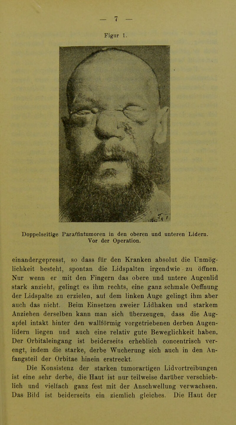 Figur 1. I Doppelseitige Parafflntumoren in den oberen und unteren Lidern. Vor der Operation. einandergepresst, so dass für den Kranken absolut die Unmög- lichkeit besteht, spontan die Lidspalten irgendwie zu öffnen. Nur wenn er mit den Fingern das obere und untere Augenlid stark anzieht, gelingt es ihm rechts, eine ganz schmale Oeffnung der Lidspalte zu erzielen, auf dem linken Auge gelingt ihm aber auch das nicht. Beim Einsetzen zweier Lidhaken und starkem Anziehen derselben kann man sich tiberzeugen, dass die Aug- apfel intakt hinter den wallförmig vorgetriebenen derben Augen- lidern liegen und auch eine relativ gute Beweglichkeit haben. Der Orbitaleingang ist beiderseits erheblich concentrisch ver- engt, indem die starke, derbe Wucherung sich auch in den An- fangsteil der Orbitae hinein erstreckt. Die Konsistenz der starken tumorartigen Lidvortreibungen ist eine sehr derbö, die Haut ist nur teilweise darüber verschieb- lich und vielfach ganz fest mit der Anschwellung verwachsen. Das Bild ist beiderseits ein ziemlich gleiches. Die Haut der