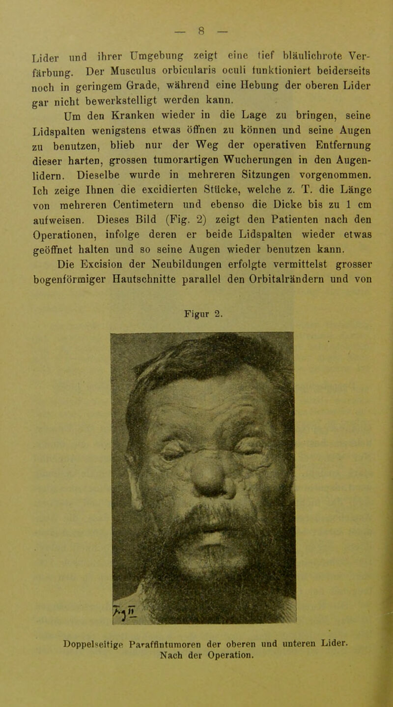 Lider und ihrer Umgebung zeigt eine tief bläuliclirote Ver- färbung. Der Musculus orbicularis oculi funktioniert beiderseits noch in geringem Grade, während eine Hebung der oberen Lider gar nicht bewerkstelligt werden kann. Um den Kranken wieder in die Lage zu bringen, seine Lidspalten wenigstens etwas öflFnen zu können und seine Augen zu benutzen, blieb nur der Weg der operativen Entfernung dieser harten, grossen tumorartigen Wucherungen in den Augen- lidern. Dieselbe wurde in mehreren Sitzungen vorgenommen. Ich zeige Ihnen die excidierten Stücke, welche z. T. die Länge von mehreren Centimetern und ebenso die Dicke bis zu 1 cm aufweisen. Dieses Bild (Fig. 2) zeigt den Patienten nach den Operationen, infolge deren er beide Lidspalten wieder etwas geöffnet halten und so seine Augen wieder benutzen kann. Die Excision der Neubildungen erfolgte vermittelst grosser bogenförmiger Hautschnitte parallel den Orbitalrändern und von Figur 2. Doppelseitige Parafflntumoren der oberen und unteren Lider. Nach der Operation.