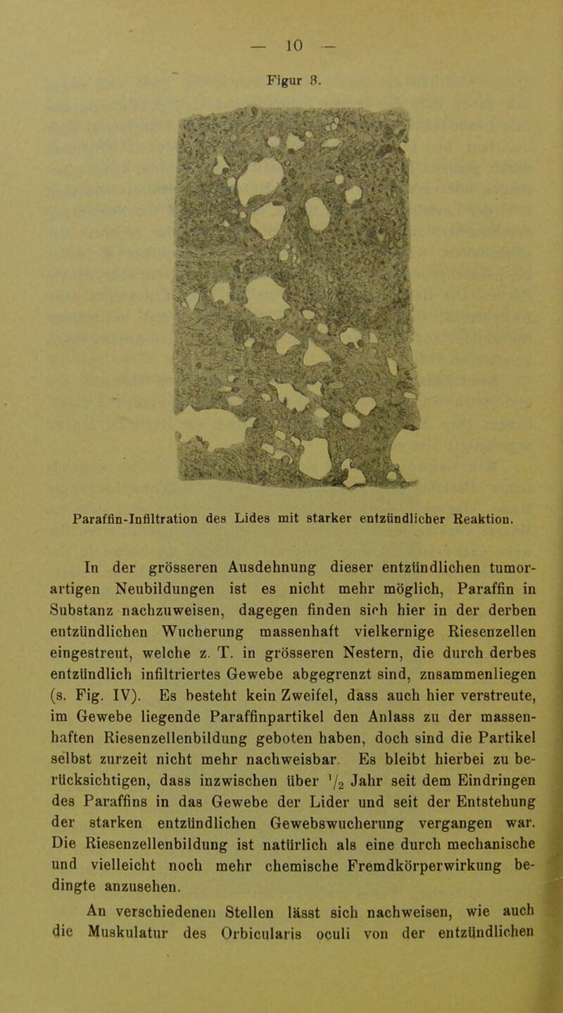 Figur 3. Paraffln-Inflltration des Lides mit starker entzündlicher Reaktion. In der grösseren Ausdehnung dieser entzündlichen tumor- artigen Neubildungen ist es nicht mehr möglich, Paraffin in Substanz nachzuweisen, dagegen finden sich hier in der derben entzündlichen Wucherung massenhaft vielkernige Riesenzellen eingestreut, welche z. T. in grösseren Nestern, die durch derbes entzündlich infiltriertes Gewebe abgegrenzt sind, zusammenliegen (s. Fig. IV). Es besteht kein Zweifel, dass auch hier verstreute, im Gewebe liegende Paraffinpartikel den Anlass zu der massen- haften Riesenzellenbildung geboten haben, doch sind die Partikel selbst zurzeit nicht mehr nachweisbar. Es bleibt hierbei zu be- rücksichtigen, dass inzwischen über '/2 Jahi' seit dem Eindringen des Paraffins in das Gewebe der Lider und seit der Entstehung der starken entzündlichen Gewebswucherung vergangen war. Die Riesenzellenbildung ist natürlich als eine durch mechanische und vielleicht noch mehr chemische Fremdkörperwirkung be- dingte anzusehen. An verschiedene)! Stellen lässt sich nachweisen, wie auch die Muskulatur des Orbicularis oculi von der entzündlichen