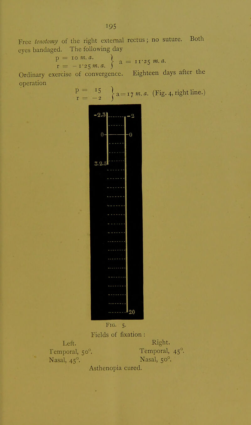 Free tenotomy of the right external rectus j no suture. Both eyes bandaged. The following day n = 10 in. a. ) 1 V a = 1125 m. a. r = - i-25 in. a. ) Ordinary exercise of convergence. Eighteen days after the operation P ^ 15 } a = 17 m. a- (Fig. 4, ght line.) Fig. 5. Fields of fixation : Left. Right. Temporal, 50°. Temporal, 45° Nasal, 45° Nasal, 50° Asthenopia cured.