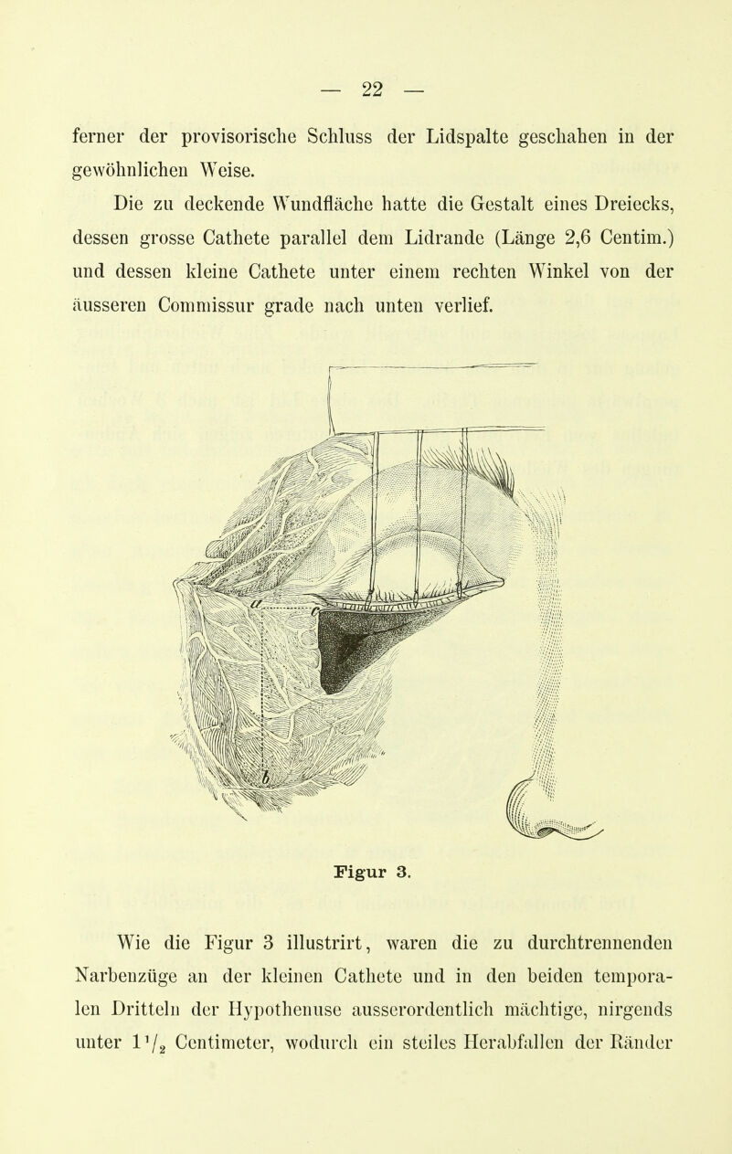 ferner der provisorische Schluss der Lidspalte geschahen in der gewöhnlichen Weise. Die zu deckende Wundfläche hatte die Gestalt eines Dreiecks, dessen grosse Cathete parallel dem Lidrande (Länge 2,6 Centim.) und dessen kleine Cathete unter einem rechten Winkel von der äusseren Commissur grade nach unten verlief. Figur 3. Wie die Figur 3 illustrirt, waren die zu durchtrennenden Narbenzüge an der kleinen Cathete und in den beiden tempora- len Dritteln der Hypothenuse ausserordentlich mächtige, nirgends unter Vj2 Centimeter, wodurch ein steiles Herabfallen der Ränder