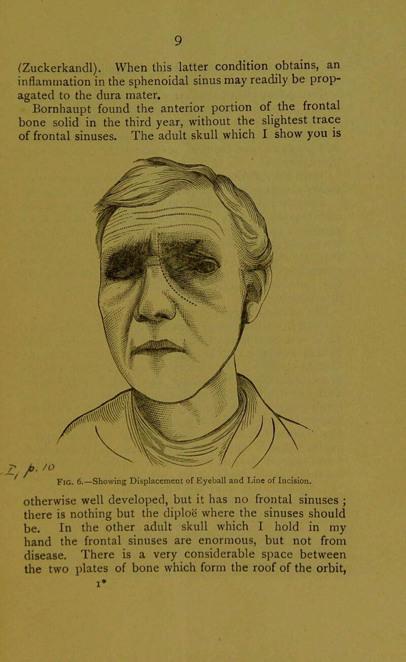 (Zuckerkandl). When this latter condition obtains, an inflammation in the sphenoidal sinus may readily be prop- agated to the dura mater. Bornhaupt found the anterior portion of the frontal bone solid in the third year, without the slightest trace of frontal sinuses. The adult skull which I show you is otherwise well developed, but it has no frontal sinuses ; there is nothing but the diploe where the sinuses should be. In the other adult skull which I hold in my hand the frontal sinuses are enormous, but not from disease. There is a very considerable space between the two plates of bone which form the roof of the orbit, I*