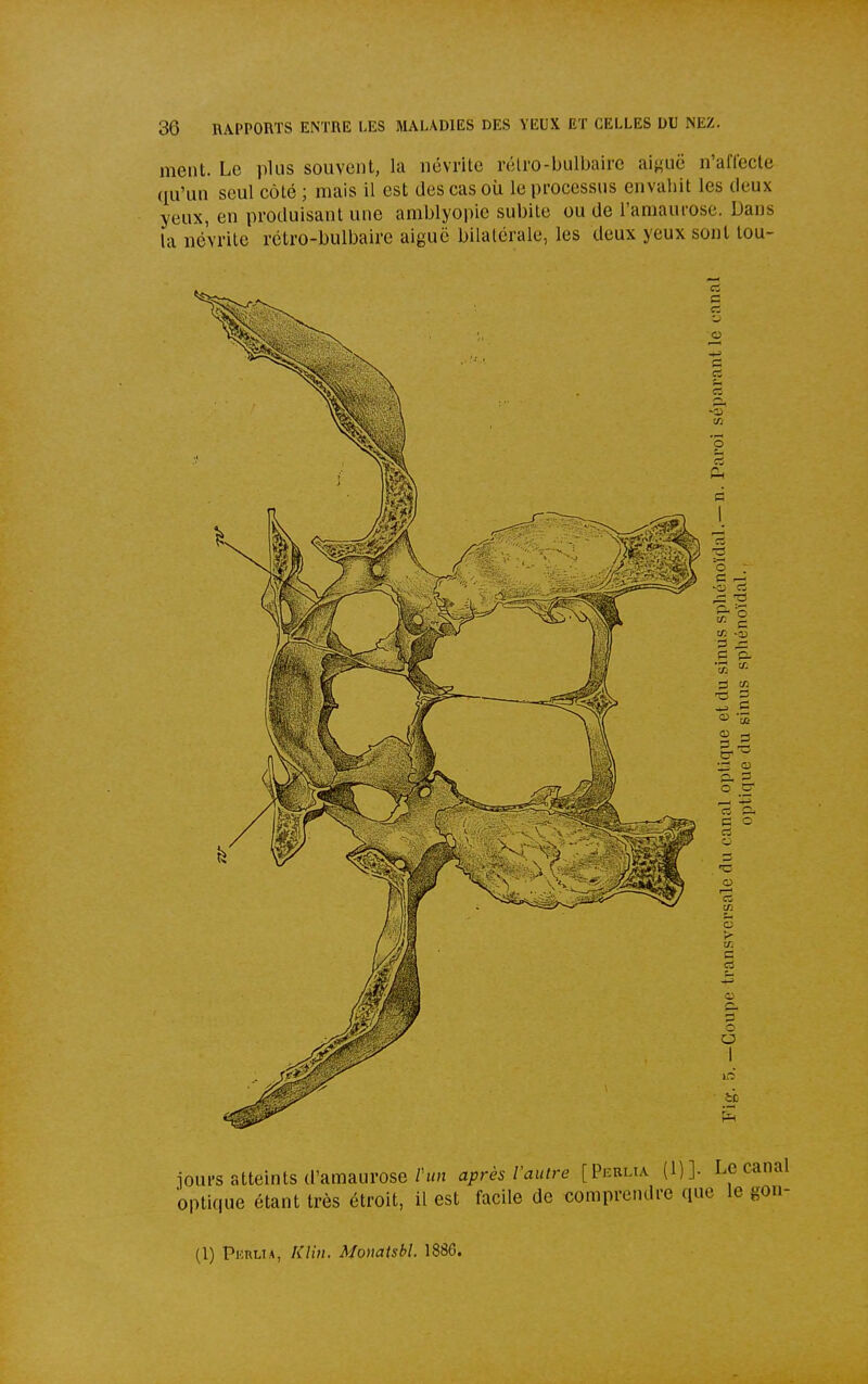 ment. Le plus souvent, la névrite rétro-bulbaire ai^uë n'affecte ([u'un seul côté ; mais il est des cas où le processus envahit les deux yeux, en produisant une amblyopie subite ou de l'amauiose. Dans la névrite rétro-bulbaire aiguë bilatérale, les deux yeux sont tou- (1) PunUA, Klin. Momtsbl. 1886.