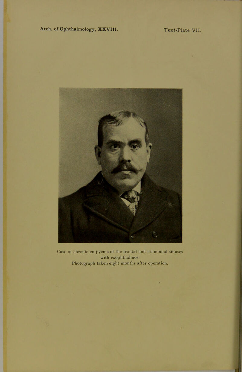 Arch. of Ophthalmology, XXVIII. Text-Plate VII. Gase of chronic empyemaof the frontal and ethmoidal sinuses with exophthalmos. Photograph taken eight months after Operation.