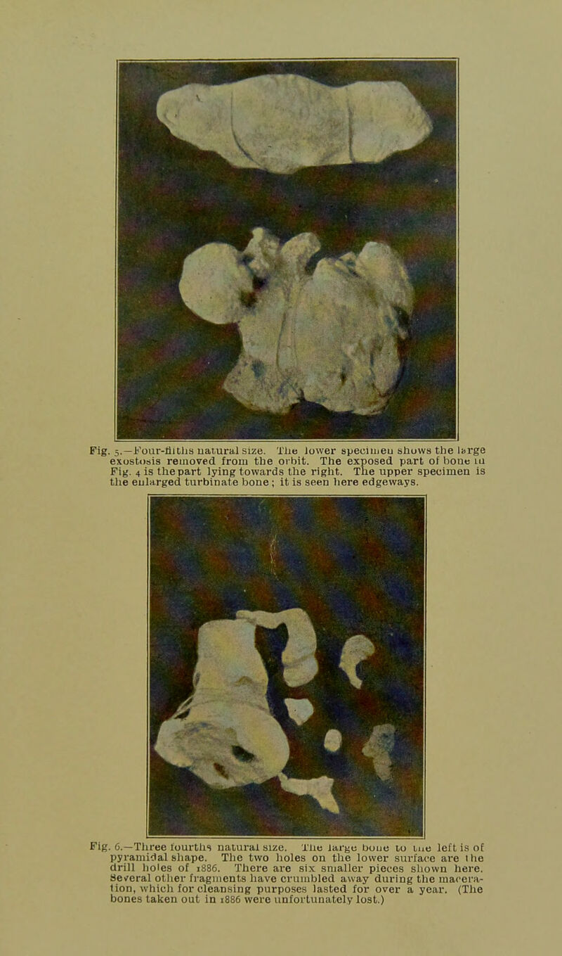 Fig. 5.—Four-tilths natural size. The lower spechueu shuws the large exostosis removed from the orbit. The exposed part of bone iu Fig. 4 is the part lying towards the right. The upper specimen is the enlarged turbinate bone; it is seen here edgeways. Fig. 6.—Three fourths natural size. Xlie targe boue to me left is of pyramidal shape. The two holes on the lower surface are 1 he drill holes of 1886. There are six smaller pieces shown here. Several other fragments have crumbled away during the macera- tion, which for cleansing purposes lasted for over a year. (The bones taken out in 1886 were unfortunately lost.)