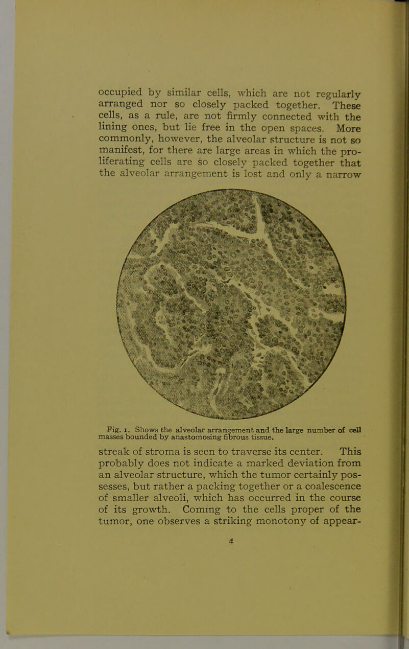 occupied by similar cells, which are not regularly- arranged nor so closely packed together. These cells, as a rule, are not firmly connected with the lining ones, but lie free in the open spaces. More commonly, however, the alveolar structure is not so manifest, for there are large areas in which the pro- liferating cells are so closely packed together that the alveolar arrangement is lost and only a narrow Fig. i. Shows the alveolar arrangement and the large number of cell masses bounded by anastomosing fibrous tissue. streak of stroma is seen to traverse its center. This probably does not indicate a marked deviation from an alveolar structure, which the tumor certainly pos- sesses, but rather a packing together or a coalescence of smaller alveoli, which has occurred in the course of its growth. Coming to the cells proper of the tumor, one observes a striking monotony of appear-