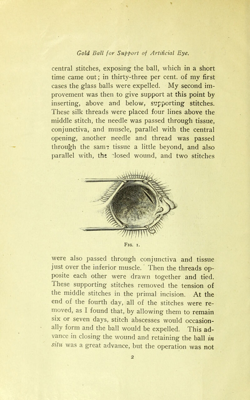 IK Gold Ball for Support of Artificial Eye. central stitches, exposing the ball, which in a short time came out; in thirty-three per cent, of my first cases the glass balls were expelled. My second im- provement was then to give support at this point by inserting, above and below, supporting stitches. These silk threads were placed four lines above the middle stitch, the needle was passed through tissue, conjunctiva, and muscle, parallel with the central opening, another needle and thread was passed through the sam? tissue a little beyond, and also parallel with, the losed wound, and two stitches Fig. i. were also passed through conjunctiva and tissue just over the inferior muscle.' Then the threads op- posite each other were drawn together and tied. These supporting stitches removed the tension of the middle stitches in the primal incision. At the end of the fourth day, all of the stitches were re- moved, as I found that, by allowing them to remain six or seven days, stitch abscesses would occasion- ally form and the ball would be expelled. This ad- vance in closing the wound and retaining the ball in situ was a great advance, but the operation was not