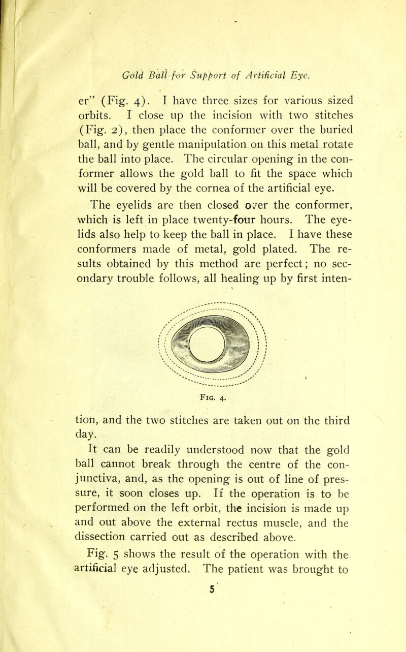 er (Fig. 4). I have three sizes for various sized orbits. I close up the incision with two stitches (Fig. 2), then place the conformer over the buried ball, and by gentle manipulation on this metal rotate the ball into place. The circular opening in the con- former allows the gold ball to fit the space which will be covered by the cornea of the artificial eye. The eyelids are then closed o^er the conformer, which is left in place twenty-four hours. The eye- lids also help to keep the ball in place. I have these conformers made of metal, gold plated. The re- sults obtained by this method are perfect; no sec- ondary trouble follows, all healing up by first inten- tion, and the two stitches are taken out on the third day. It can be readily understood now that the gold ball cannot break through the centre of the con- junctiva, and, as the opening is out of line of pres- sure, it soon closes up. If the operation is to be performed on the left orbit, the incision is made up and out above the external rectus muscle, and the dissection carried out as described above. Fig. 5 shows the result of the operation with the artificial eye adjusted. The patient was brought to Fig. 4.