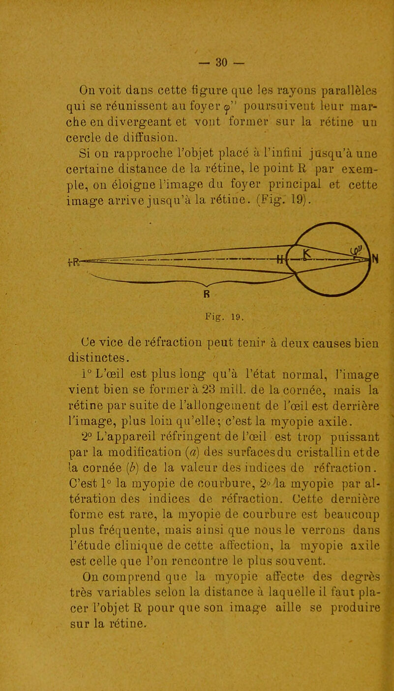 On voit dans cette figure que les rayons parallèles qui se réunissent au foyer <j> poursuivent leur mar- che en divergeant et vont former sur la rétine un cercle de diffusion. Si on rapproche l'objet placé à l'infini jusqu'à une certaine distance de la rétine, le point R par exem- ple, on éloigne l'image du foyer principal et cette image arrive jusqu'à la rétine. (Fig; 19). Fig. 19. Ce vice de réfraction peut tenir à deux causes bien distinctes. 1° L'œil est plus long qu'à l'état normal, l'image vient bien se former à 23 mi 11. de la cornée, mais la rétine par suite de l'allongement de l'œil est derrière limage, plus loin qu'elle; c'est la myopie axile. 2° L'appareil réfringent de l'œil est trop puissant par la modification (a) des surfacesdu cristallin et de la cornée (b) de la valeur des indices de réfraction. C'est 1° la myopie de courbure, 2°la myopie par al- tération des indices de réfraction. Cette dernière forme est rare, la myopie de courbure est beaucoup plus fréquente, mais ainsi que nous le verrons dans l'étude clinique de cette affection, la myopie axile est celle que l'on rencontre le plus souvent. On comprend que la myopie affecte des degrés très variables selon la distance à laquelle il faut pla- cer l'objet R pour que son image aille se produire sur la rétine.