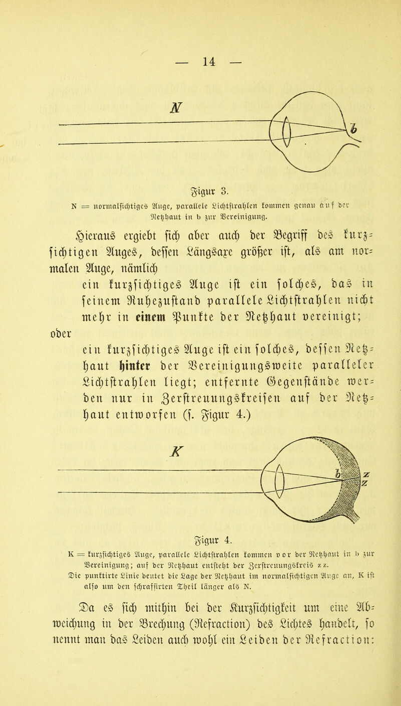 ^igur 3. N = nortnalftd^tigce 2Iugc, paraKele Sid;tftral;kn fommen genau auf bor 5Jel}l}aut in b juv ^Bereinigung. ^kxau§> ergiebt fid; aber anä) ber S3egriff be^ tni^= fi(^^tigen luge^, beffen £äng§ayc größer ift, aB am iior= malen Sluge, nämli($ ein furjfid;tige§ Sluge ift ein fotd)eö, baö in feinem 9flu!)eguftanb parallele Sid^tftral)Ien ni^t mel)r in einem fünfte ber 5Jle^l)aiit vereinigt; ober ein furgfid)tigeg SCuge ift ein fold)e§, beffcu 91e|^ l)aut l^itttet ber ^Sereinigung^meite paralleler Sid)tftral)len liegt; entfernte ^egenftänbe TOer^ ben nur in Qtx\ixtuvinQ^ht\\tn auf ber dU% = l)aut entmorfen (f. gigur 4.) %mv 4. K = furäfid^tigeS Sluge, paraltete £^c^t^tra^)^en lEommen r>cr ber 9]ct't)aut in b jur SSereintgung; auf ber ^le^Jjaut entfteJ)t ber gerftrcuungefreiQ zz. Sie punftirte Sinie beutet bie Sage ber 3kiitiaut im normatfidjtigen 2Uigc an, K ift alfo um ben fd;raffirten länger als N. T)a e§ fid; mitl)in bei ber to§ftd;tigfcit um eine Slb- meidjung in ber ^rediung (Sfiefraction) be§ fiid;te§ l^anbelt, fo nennt mau ba§ £eiben aud) moljl ein Sei ben ber 9iefraction: