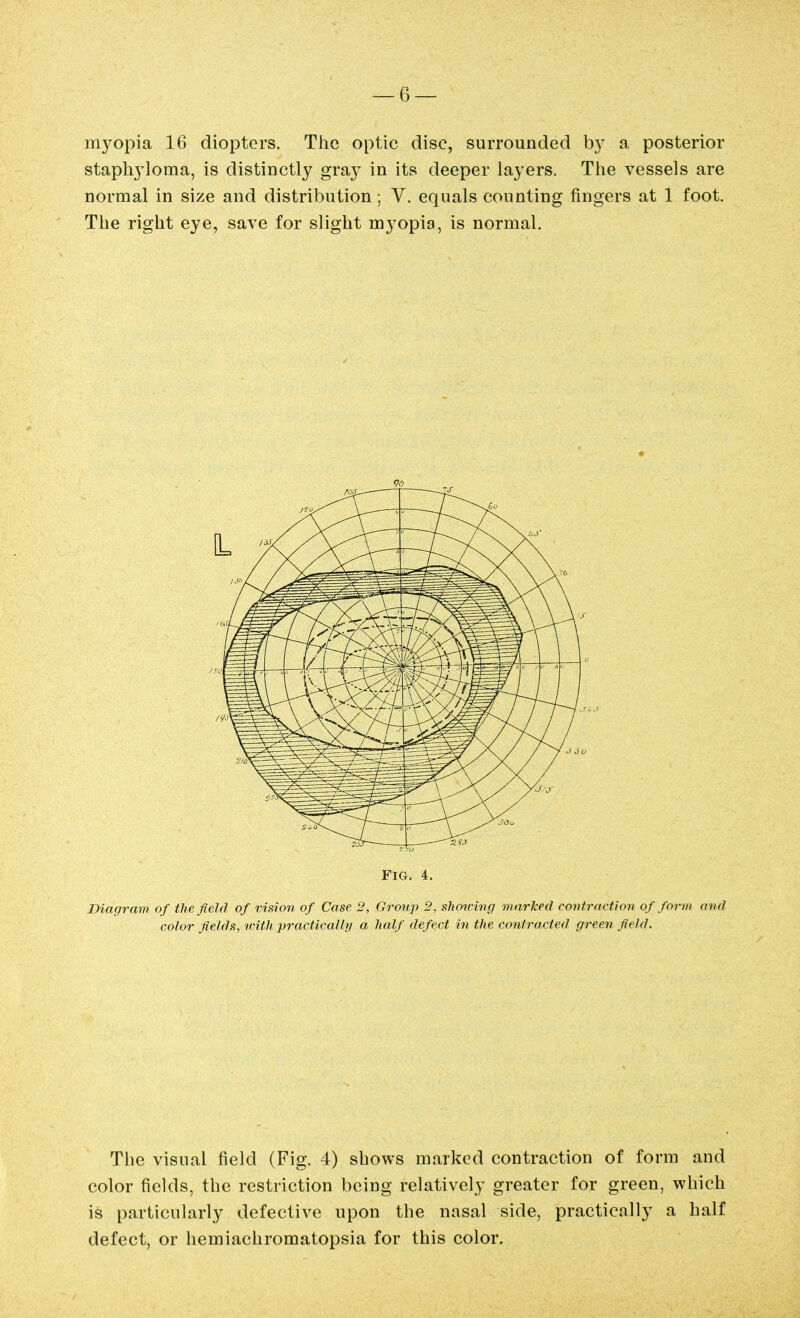 myopia 16 diopters. The optic disc, surrounded b}^ a posterior staphjioma, is distinctly gra}^ in its deeper layers. The vessels are normal in size and distribution; V. equals counting fingers at 1 foot. The right eye, save for slight myopia, is normal. Fig. 4. Diagram of the field of vision of Case 2, Group 2, slwwing marked coniracttov of form avd color fields, with practically a half defect in the contracted green field. The visual field (Fig. 4) shows marked contraction of form and color fields, the restriction being relatively greater for green, which is particularly defective upon the nasal side, practically a half defect, or hemiachromatopsia for this color.