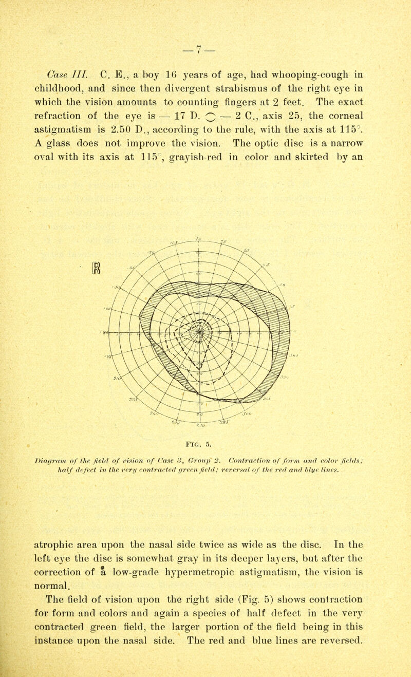 childhood, and since then divergent strabismus of the right eye in which the vision amounts to counting fingers at 2 feet. The exact refraction of the eye is — 17 D. Q — 2 C, axis 25, the corneal astigmatism is 2.50 D., according to the rule, with the axis at 115^. A glass does not improve the vision. The optic disc is a narrow oval with its axis at 115 , grayish-red in color and skirted by an Fig. 5. Diagram of the field of ins ion of Case 8, Group 2. Contraction of form arul color fields; half defect in the very contracted green field; reversal of the red and hlyte lines. atrophic area upon the nasal side twice as wide as the disc. In the left eye the disc is somewhat gray in its deeper layers, but after the correction of a low-grade hypermetropic astigmatism, the vision is normal. The field of vision upon the right side (Fig. 5) shows contraction for form and colors and again a species of half defect in the very contracted green field, the larger portion of the field being in this instance upon the nasal side. The red and blue lines are reversed.