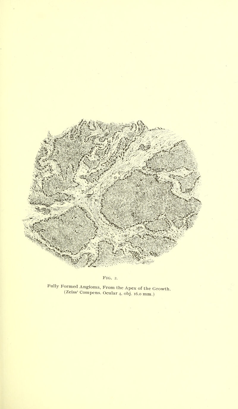 Fig. 2. Fully Formed Angioma, From the Apex of the Growth. (Zeiss' Compens. Ocular 4, obj. 16.0 mm.)