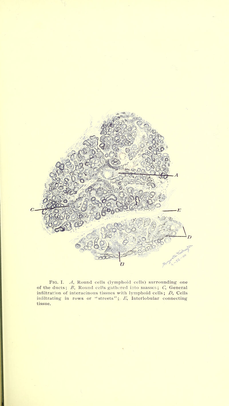 Fig. I. A, Round cells Oymphoid cells) surrounding one of the ducts; B, Round cells gathered into naasses; C, General infiltration of interacinous tissues with lymphoid cells; D, Cells infiltrating in rows or streets; E, Interlobular connecting tissue.