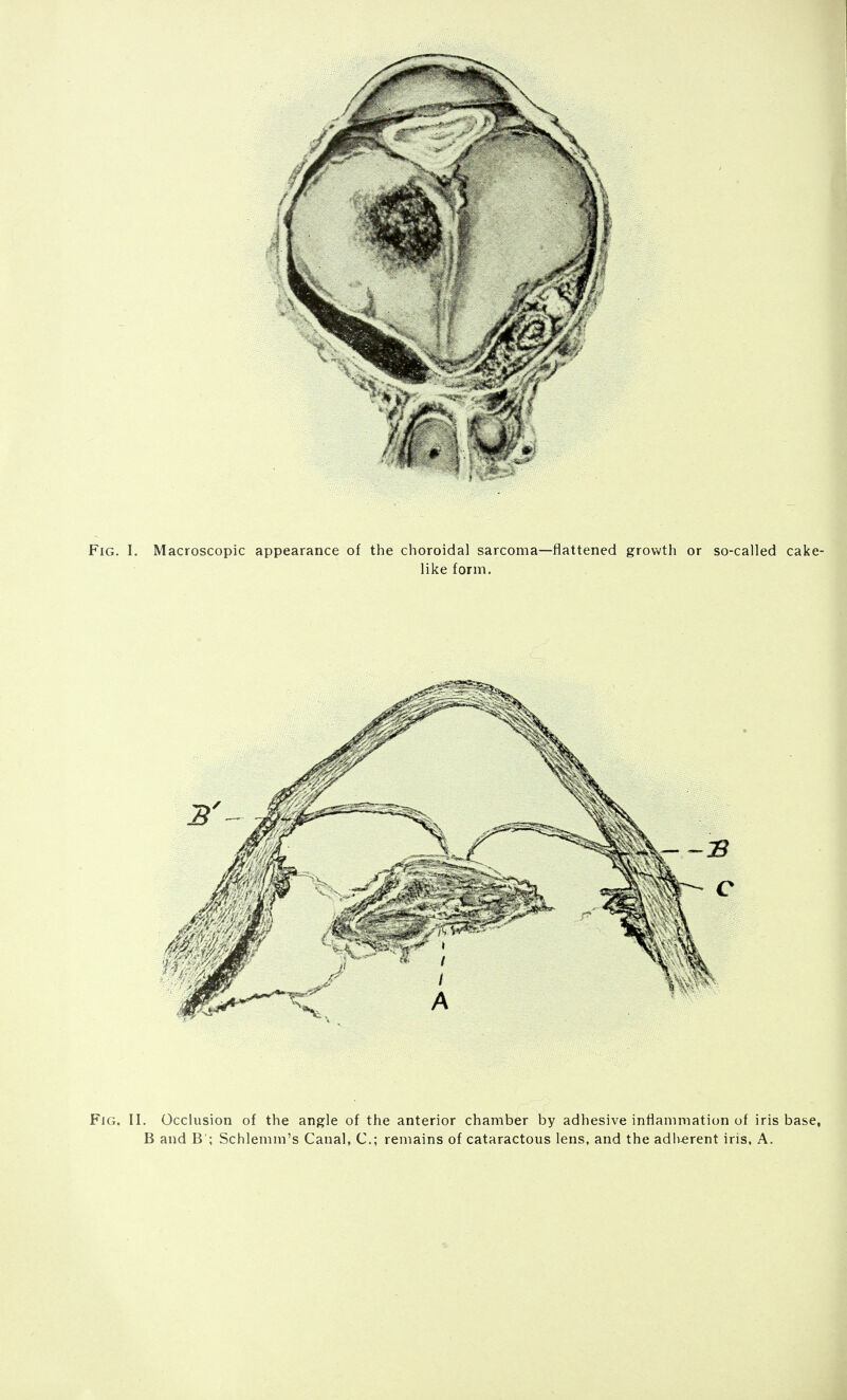 B and B'; Schlemm's Canal, C; remains of cataractous lens, and the adherent iris, A.