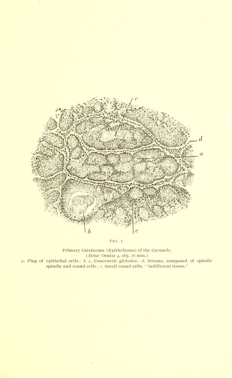 Primary Carcinoma (Epithelioma) of the Caruncle. (Zeiss' Ocular 4, obj. 16 mm.) a. Plug of epithelial cells; b, c, Concentric globules; d, Stroma, composed of spindle spindle and round cells ; e, Small round cells.  indifferent tissue.