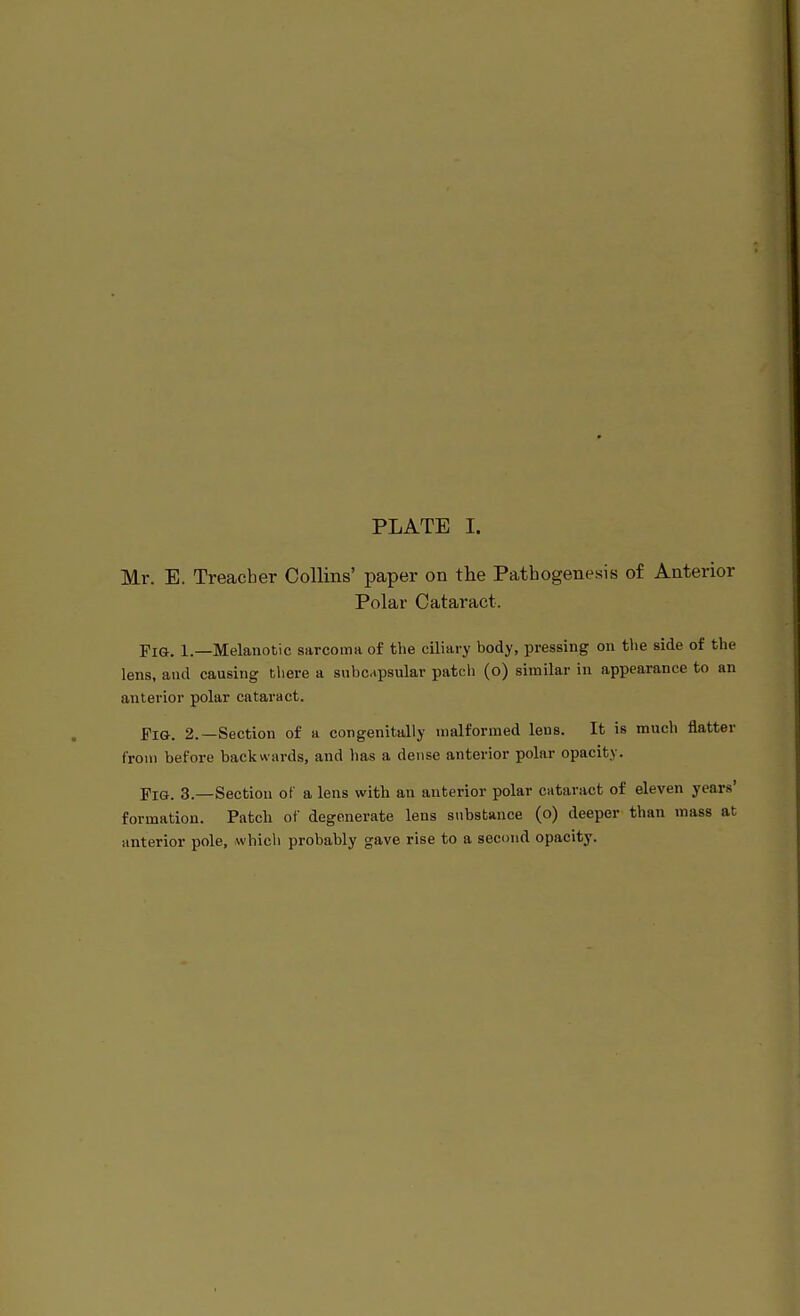 PLATE I. Mr. E. Treacher Collins' paper on the Pathogenesis of Anterior Polar Cataract. Fig. 1.—Melanotic surcoina of the ciliary body, pressing on the side of the lens, and causing tliere a subcapsular patch (o) similar in appearance to an anterior polar cataract. Pig-. 2.—Section of a congenitally malformed leus. It is much flatter from before backwards, and has a dense anterior polar opacity. Fig. 3.—Section of a lens with an anterior polar cataract of eleven years' formation. Patch of degenerate lens substance (o) deeper than mass at anterior pole, which probably gave rise to a second opacity.