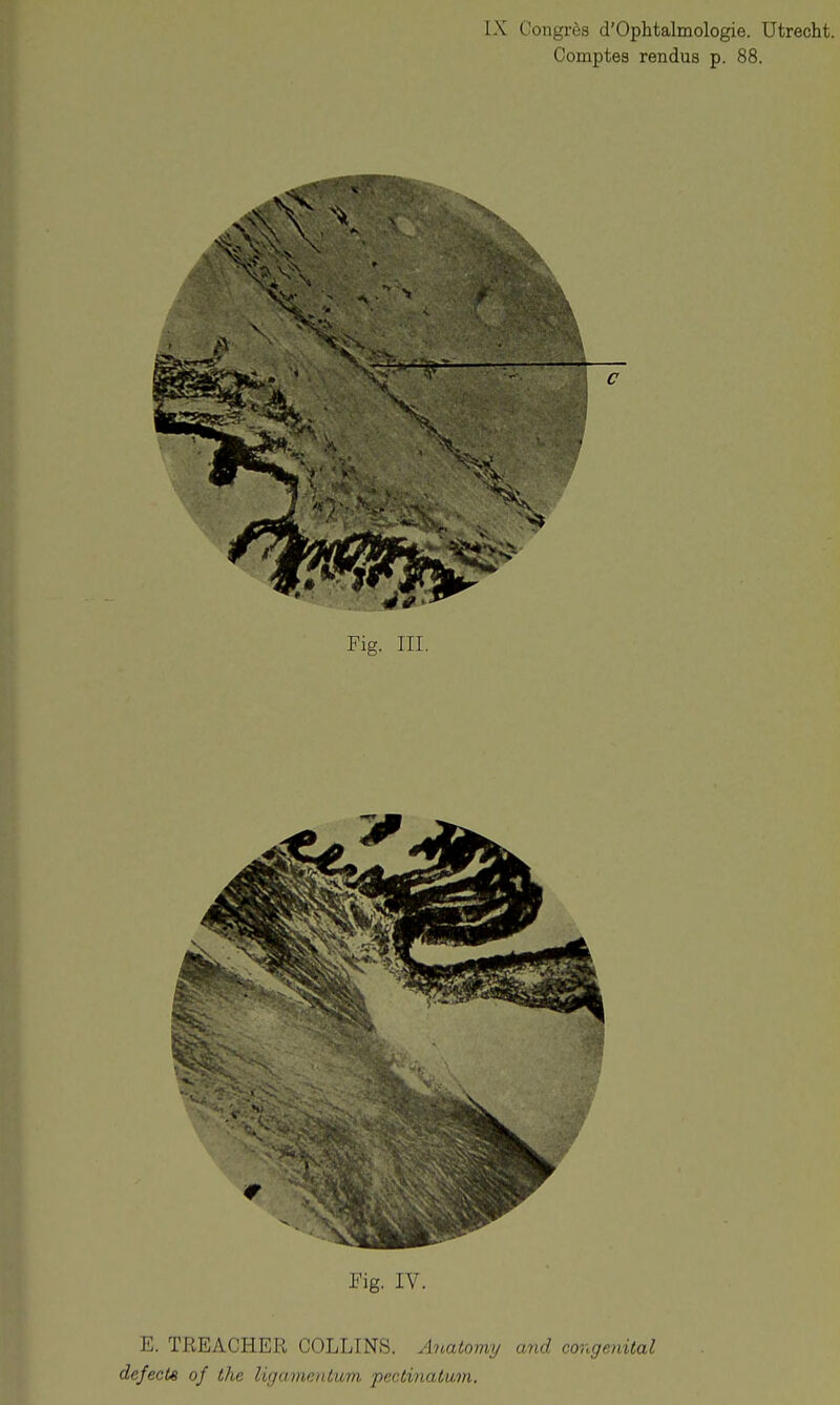 Comptes rendus p. 88. Fig. III. Fig. IV. E. TREACHER COLLINS. Anatomt/ and congenital