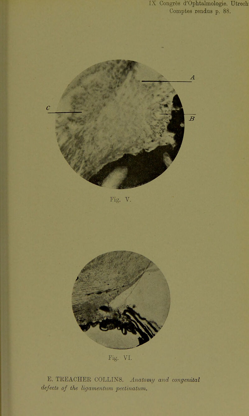 Comptes rendus p. 88. Fig. VI. E. TREACHER COLLINS. Anatomy and congenital