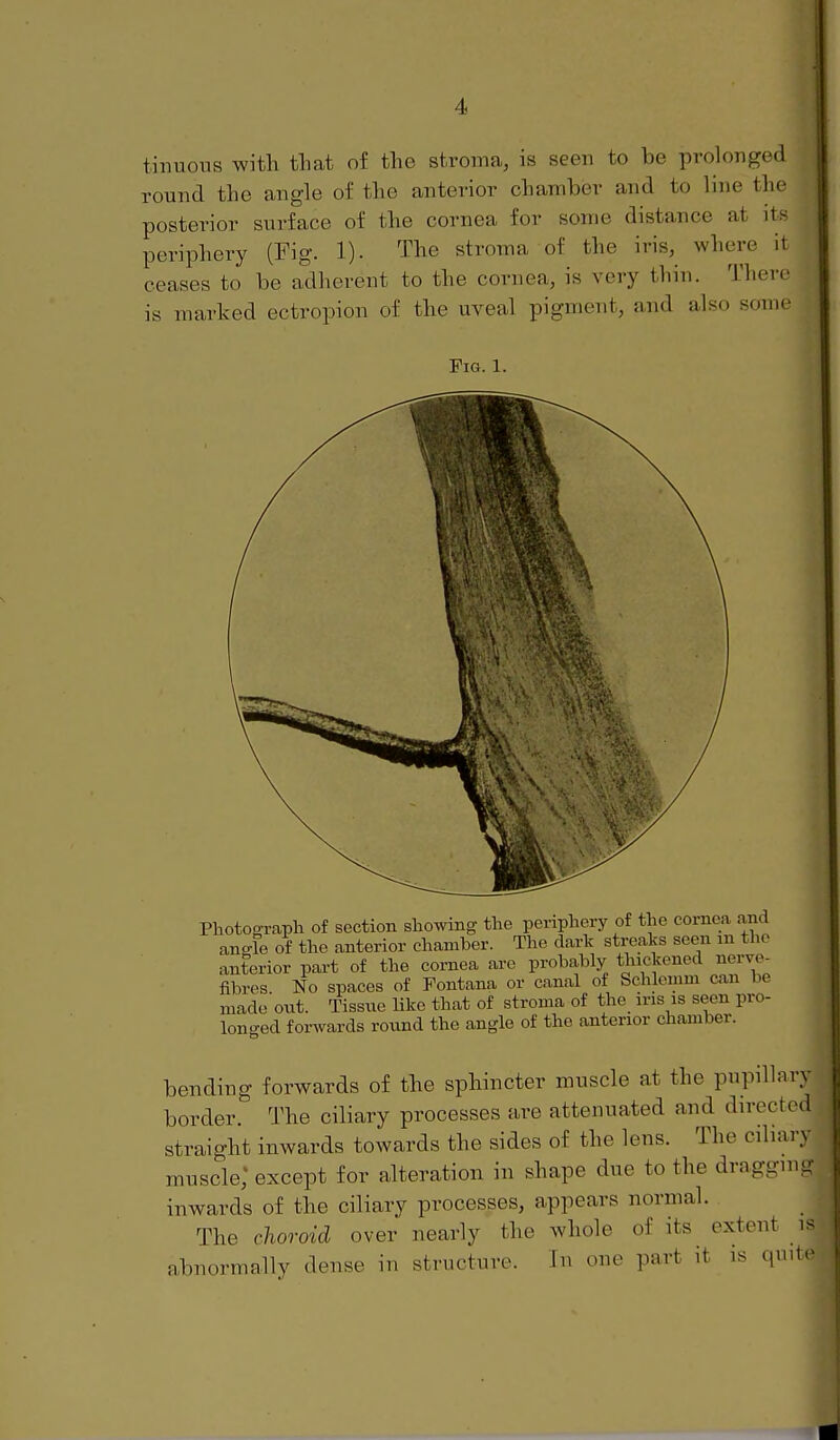 tinuous with tliat of the stroma, is seen to be prolonged round the angle of the anterior chamber and to line the posterior surface of the cornea for some distance at its periphery (Fig. 1). The stroma of the iris, where it ceases to be adherent to the cornea, is very thin. There is marked ectropion of the uveal pigment, and also some Fig. 1. Photograph of section showing the periphery of the cornea and ano-le of the anterior chamber. The dark streaks seen m the anterior part of the cornea are probably thickened nerve^ fibres No spaces of Fontana or canal of Schlemm can be made out. Tissue like that of stroma of the ins is seen pro- lono-ed forwards round the angle of the anterior chamber. bending forwards of the sphincter muscle at the pupillar border. The ciliary processes are attenuated and directe straight inwards towards the sides of the lens. The ciliary muscle; except for alteration in shape due to the draggm- inwards of the ciliary processes, appears normal. The choroid over nearly the whole of its extent is abnormally dense in structure. In one part it is quit