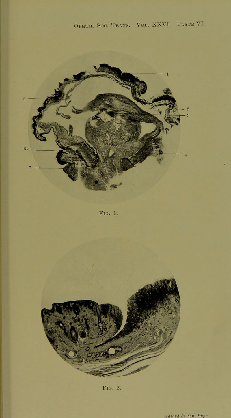 Ophth. Soc. Tbans. Vol. XXVI. Plate VI. Fig. 1. Adlard & Son, Impr.