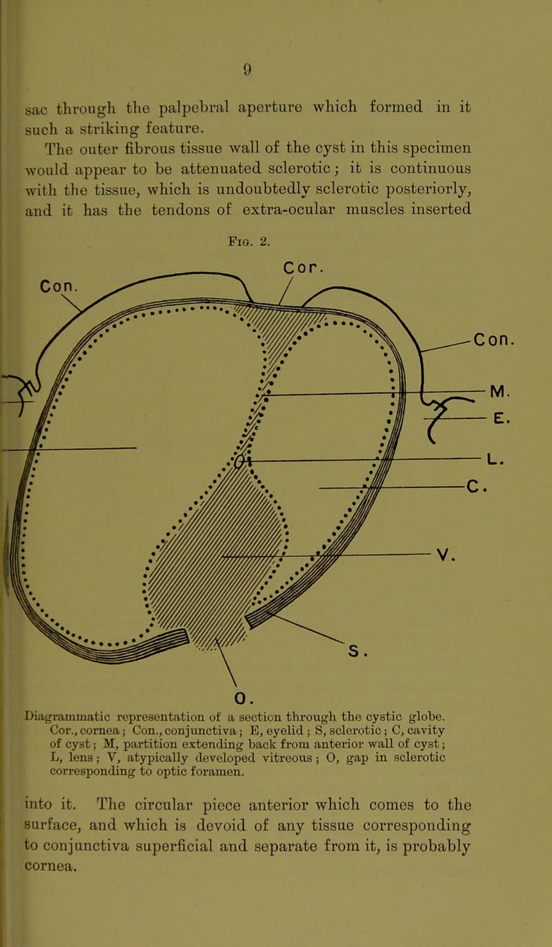 sac through the palpebral aperture which formed in it such a striking feature. The outer fibrous tissue wall of the cyst in this specimen would appear to be atteniiated sclerotic; it is continuous with the tissue, which is undoubtedly sclerotic posteriorly, and it has the tendons of extra-ocular muscles inserted Fig. 2. Cor. 0. Diagrammatic representation of a section through the cystic globe. Cor., cornea; Con., conjunctiva; E, eyelid ; S, sclerotic; C, cavity of cyst; M, partition extending back from anterior wall of cyst; L, lens; V, atypically developed vitreous; 0, gap in sclerotic corresponding to optic foramen. into it. The circular piece anterior which comes to the surface, and which is devoid of any tissue corresponding to conjunctiva superficial and separate from it, is probably cornea.