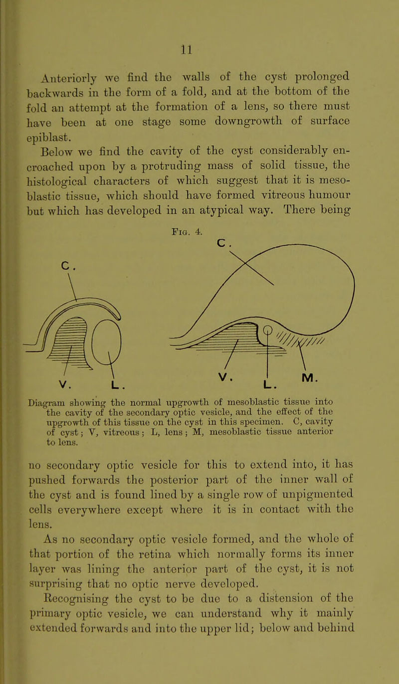 Anteriorly we find the walls of the cyst prolonged backwards in the form of a fold^ and at the bottom of the fold an attempt at the formation of a lens, so there must have been at one stage some downgrowth of surface epiblast. Below we find the cavity of the cyst considerably en- croached upon by a protruding mass of solid tissue, the histological characters of which suggest that it is meso- blastic tissue, which should have formed vitreous humour but which has developed in an atypical way. There being Fig. 4. Diagi-am showing the normal upgrowth of mesoblastic tissue into the cavity of the secondary optic vesicle, and the effect of the upgrowth of this tissue on the cyst in this specimen. C, cavity of cyst; V, vitreous; L, lens; M, mesoblastic tissue anterior to lens. no secondary optic vesicle for this to extend into, it has pushed forwards the posterior part of the inner wall of the cyst and is found lined by a single row of unpigmented cells everywhere except where it is in contact with the lens. As no secondary optic vesicle formed, and the whole of that portion of the retina which normally forms its inner layer was lining the anterior part of the cyst, it is not surprising that no optic nerve developed. Recognising the cyst to be due to a distension of the primary optic vesicle, we can understand why it mainly extended forwards and into the upper lid; below and behind