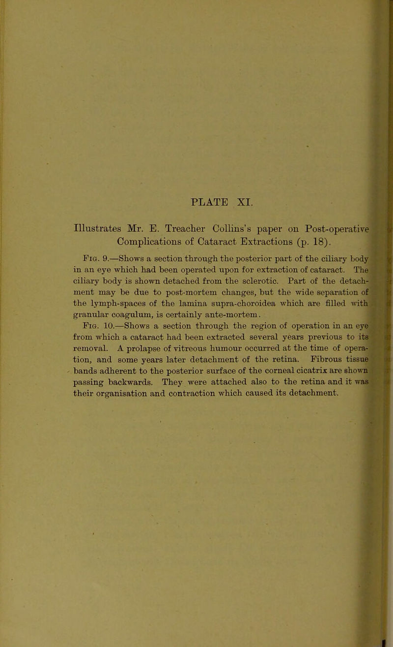 PLATE XI. Illustrates Mr. E. Treacher Collins's paper on Post-operativa Complications of Cataract Extractions (p. 18). Fig. 9.—Shows a section through the posterior part of the ciliary body in an eye which had been operated upon for extraction of cataract. The ciliary body is shown detached from the sclerotic. Part of the detach- ment may be due to post-mortem changes, but the wide separation of the lymph-spaces of the lamina supra-choroidea which are filled with grantdar coagulum, is certainly ante-mortem. Pig. 10.—Shows a section through the region of operation in an eye from which a cataract had been extracted several years previous to its removal. A prolapse of vitreous humour occurred at the time of opera- tion, and some years later detachment of the retina. Fibrous tissue bands adherent to the posterior siirface of the corneal cicatrix are shown passing backwards. They were attached also to the retina and it was their organisation and contraction which caused its detachment.