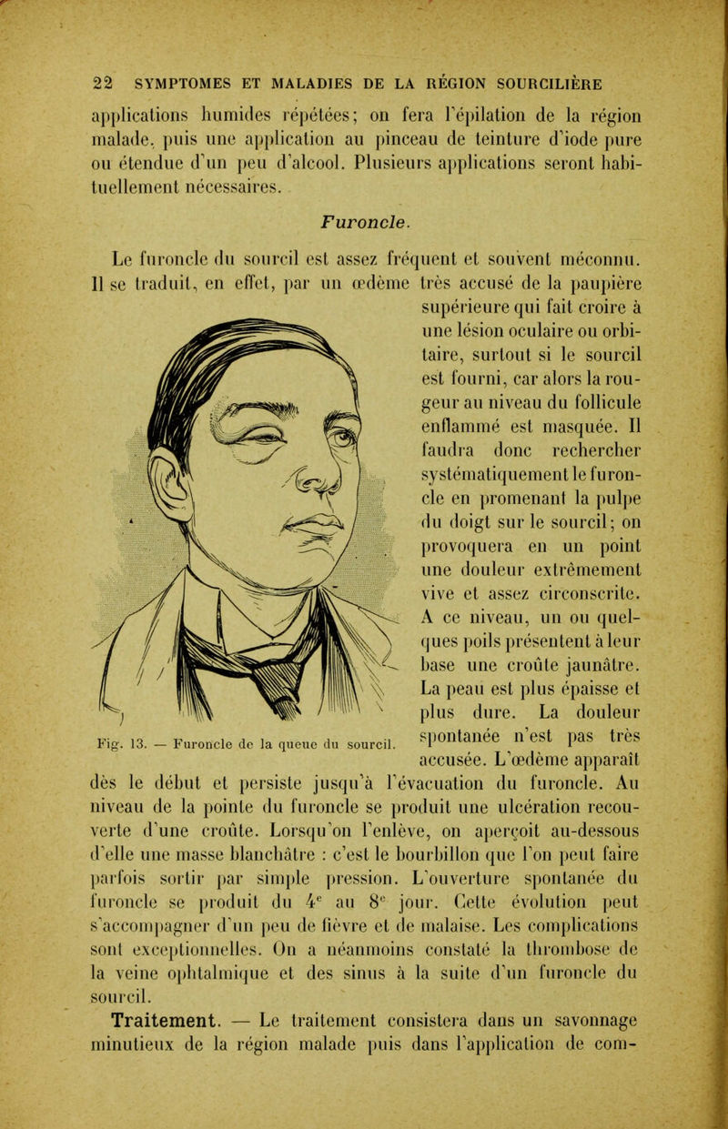 applications humides répétées; on fera Tépilation de la région malade, puis une application au pinceau de teinture d'iode pure ou étendue d'un peu d'alcool. Plusieurs applications seront habi- tuellement nécessaires. Le furoncle du sourcil est assez fréquent et souvent méconnu. 11 se traduit, en effet, par un œdème très accusé de la paupière dès le début et persiste jusqu'à l'évacuation du furoncle. Au niveau de la pointe du furoncle se produit une ulcération recou- verte d'une croûte. Lorsqu'on l'enlève, on aperçoit au-dessous d'elle une masse blanchâtre : c'est le bourbillon que l'on peut faire parfois sortir par simple pression. L'ouverture spontanée du furoncle se produit du 4*^ au 8 jour. Cette évolution peut s'accompagner d'un peu de fièvre et de malaise. Les comphcations sont exceptionnelles. On a néanmoins constaté la thrombose de la veine ophtalmique et des sinus à la suite d'un furoncle du sourcil. Traitement. — Le traitement consistera dans un savonnage minutieux de la région malade puis dans l'application de com- Fur oncle. Fig. 13. — Furoncle de la queue du sourcil. supérieure qui fait croire à une lésion oculaire ou orbi- taire, surtout si le sourcil est fourni, car alors la rou- geur au niveau du follicule enflammé est masquée. Il faudra donc rechercher systématiquement le furon- cle en promenant la pulpe du doigt sur le sourcil; on provoquera en un point une douleur extrêmement vive et assez circonscrite. A ce niveau, un ou quel- ques poils présentent à leur base une croûte jaunâtre. La peau est plus épaisse et plus dure. La douleur spontanée n'est pas très accusée. L'œdème apparaît