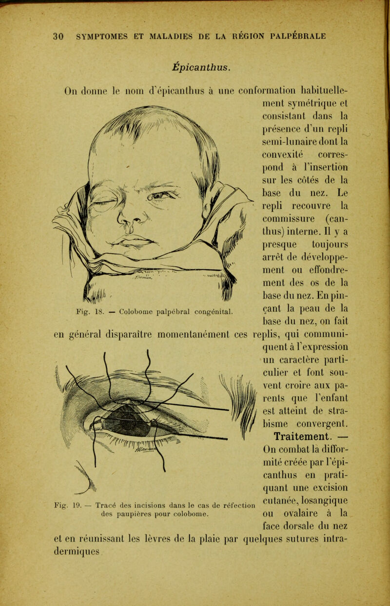 Epicanthus. On donne le nom d'épicanthiis à une conformation habituelle- ment symétrique et consistant dans la présence d'un repli semi-lunaire dont la convexité corres- pond à rinsertion sur les côtés de la base du nez. Le repli recouvre la commissure (can- thus) interne. Il y a presque toujours arrêt de développe- ment ou effondre- ment des os de la base du nez. En pin- çant la peau de la base du nez, on fait eplis, qui communi- quent à l'expression un caractère parti- culier et font sou- vent croire aux pa- rents que Tenfant est atteint de stra- bisme convergent. Traitement. — On combat la diffor- mité créée par Tépi- canthus en prati- quant une excision cutanée, losangique ou ovalaire à la face dorsale du nez et en réunissant les lèvres de la plaie par quelques sutures intra- dermiques Fig. 18. — Colobonie palpébral congénital. en général disparaître momentanément ces Fig. 19. Tracé des incisions dans le cas de réfection des paupières pour colobome.