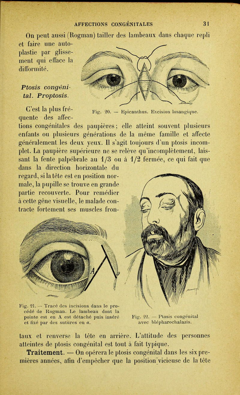 Fig. 20. — Epicanthus. Excision losangique. On peut aussi (Rogman) tailler des lambeaux dans chaque repli et faire une auto- plastie par glisse- ment qui efface la difformité. Ptosis congéni- tal. Proptosis. C'est la plus fré- quente des affec- tions congénitales des paupières; elle atteint souvent plusieurs enfants ou plusieurs générations de la même famille et affecte généralement les deux yeux. Il s'agit toujours d'un ptosis incom- plet. La paupière supérieure ne se relève qu'incomplètement, lais- sant la fente palpébrale au 1/3 ou à i/2 fermée, ce qui fait que dans la direction horizontale du regard, si la tête est en position nor- male, la pupille se trouve en grande partie recouverte. Pour remédier à cette gêne visuelle, le malade con- tracte fortement ses muscles fron- Fig. 21. — Tracé dos incisions dans le pro- cédé de Rogman. Le lambeau dont la pointe est en A est détaché puis inséré et fixé par des sutures en a. Fig. 2-2. — Ptosis congénital avec blépharochalazis. taux et renverse la tête en arrière. L'attitude des personnes atteintes de ptosis congénital est tout à fait typique. Traitement. — On opérera le ptosis congénital dans les six pre- mières années, afin d'empêcher que la position^icieuse de la tête