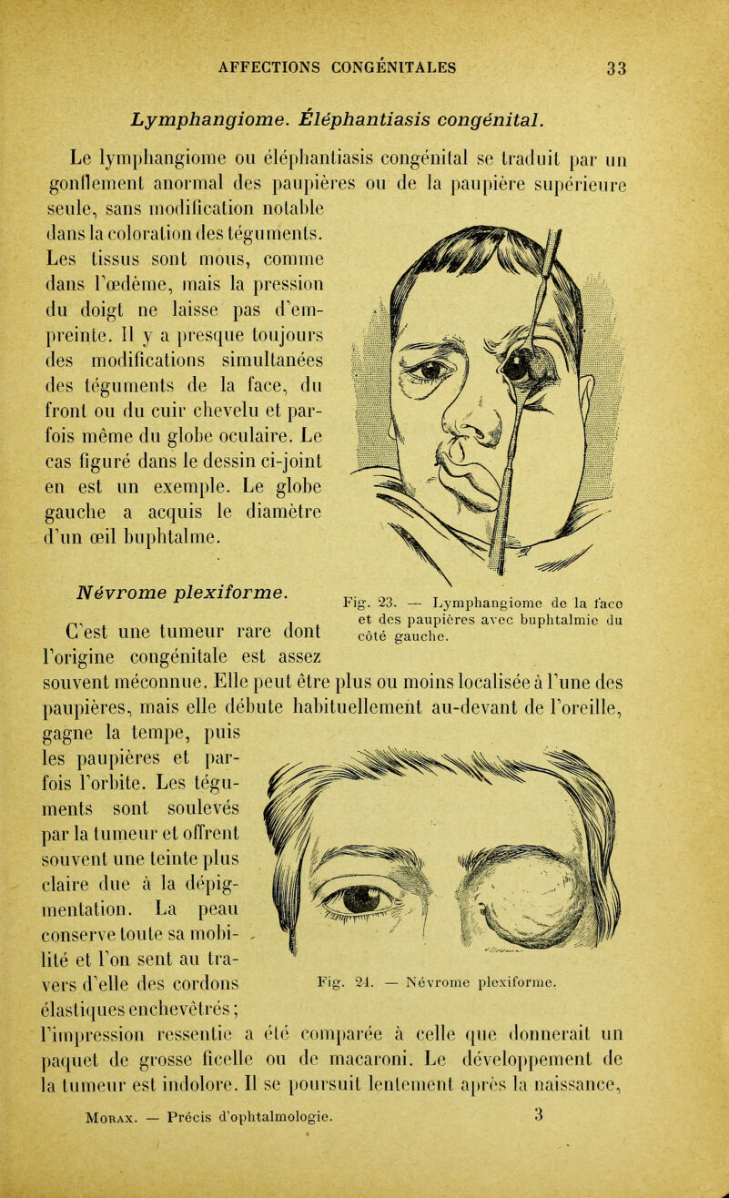 Lymphangiome. Eléphantiasis congénital. Le lymphangiome ou éléphantiasis congénital se traduit par un gonflement anormal des paupières ou de la paupière supérieure seule, sans modification notable dans la coloration des téguments. Les tissus sont mous, comme dans Fœdème, mais la pression du doigt ne laisse pas d'em- preinte. Il y a presque toujours des modifications simultanées des téguments de la face, du front ou du cuir chevelu et par- fois même du globe oculaire. Le cas figuré dans le dessin ci-joint en est un exemple. Le globe gauche a acquis le diamètre d'un œil buphtalme. Névrome plexiforme. Fig. 23. — Lymphangiome de la l'ace et des paupières avec buplitalmie du côté gauche. C'est une tumeur rare dont Torigine congénitale est assez souvent méconnue. Elle peut être plus ou moins localisée à Tune des paupières, mais elle débute habituellement au-devant de foreille, gagne la tempe, puis les paupières et par- fois Torbite. Les tégu- ments sont soulevés par la tumeur et offrent souvent une teinte plus claire due à la dépig- mentation. La peau conserve toute sa mobi- . lité et Ton sent au tra- vers d'elle des cordons élastiques enchevêtrés ; l'impression ressentie a paquet de grosse ficelle la tumeur est indolore. Il se poursuit lentement après la naissance, MoRAX. — Précis d'ophtalmologie. 3 Fig. 2-1. — Névrome plexiforme. été comparée à celle que donnerait un ou de macaroni. Le développement de