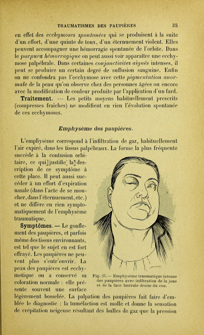 en effet des ecchymoses spontanées qui se produisent à la suite d'un effort, d'une quinte de toux, d'un éternuement violent. Elles peuvent accompagner une hémorragie spontanée de l'orbite. Dans le purpura hémorragique on peut aussi voir apparaître une ecchy- mose palpébrale. Dans certaines conjonctivites aiguës intenses, il peut se produire un certain degré de suffusion sanguine. Enfin on ne confondra pas l'ecchymose avec cette pigmentation anor- male de la peau qu'on observe chez des personnes âgées ou encore avec la modification de couleur produite par l'apphcation d'un fard. Traitement. — Les petits moyens habituellement prescrits (compresses fraîches) ne modifient en rien l'évolution spontanée de ces ecchymoses. Emphysème des paupières. L'emphysème correspond à l'infiltration de gaz, habituellement l'air expiré, dans les tissus palpébraux. La forme la plus fréquente succède à la contusion orbi- taire, ce qui]justifie] la] des- cription de ce symptôme à cette place. Il peut aussi suc- céder à un effort d'expiration nasale (dans l'acte de se mou- cher, dans l'éternuement, etc. ) et ne diffère en rien sympto- matiquement de l'emphysème traumatique. Symptômes. — Le gonfle- ment des paupières, et parfois même des tissus environnants, est tel que le sujet en est fort effrayé. Les paupières ne peu- vent plus s'entr'ouvrir. La peau des paupières est ecchy- motique ou a conservé sa Fig.-25.—Emphysème traumatique intense coloration normale : elle pré- des paupières avec inliltration de la joue i et de la lace latérale droite du cou. sente souvent une surface légèrement bosselée. La palpation des paupières fait faire d'em- blée le diagnostic : la tuméfaction est molle et donne la sensation de crépitation neigeuse résultant des bulles de gaz que la pression