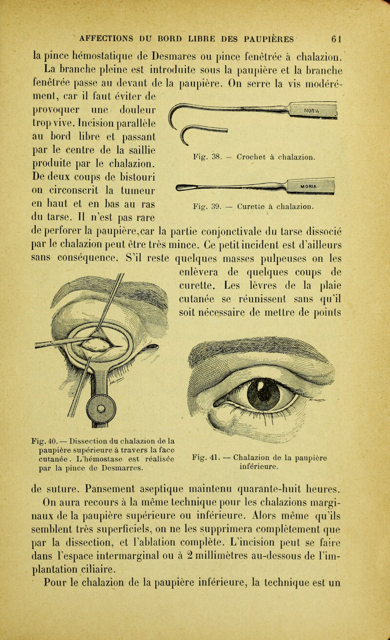 la pince hémostatique de Desmares ou pince fenêtrée à chalazion. La branche pleine est introduite sous la paupière et la branche fenêtrée passe au devant de la paupière. On serre la vis modéré- ment, car il faut éviter de provoquer une douleur trop vive. Incision parallèle au bord libre et passant par le centre de la sailHe produite par le chalazion. De deux coups de bistouri on circonscrit la tumeur en haut et en bas au ras du tarse. Il n est pas rare de perforer la paupière,car la partie conjonctivale du tarse dissocié par le chalazion peut être très mince. Ce petit incident est d'ailleurs sans conséquence. S'il reste quelques masses pulpeuses on les enlèvera de quelques coups de curette. Les lèvres de la plaie cutanée se réunissent sans qu'il soit nécessaire de mettre de points Fig. 38. - Crochet à chalazion. Fig-. 39. — Curette à chalazion. Fig. 40. — Dissection du chalazion de la paupière supérieure à travers la face cutanée. L'hémostase est réalisée par la pince de Desmarres. Fiff. 41. Chalazion de la paupière inférieure. de suture. Pansement aseptique maintenu quarante-huit heures. On aura recours à la même technique pour les chalazions margi- naux de la paupière supérieure ou inférieure. Alors même qu'ils semblent très superficiels, on ne les supprimera complètement que par la dissection, et l'ablation complète. L'incision peut se faire dans l'espace intermarginal ou à 2 millimètres au-dessous de l'im- plantation ciliaire. Pour le chalazion de la paupière inférieure, la technique est un