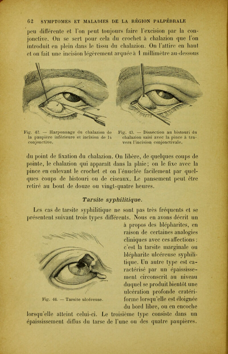 peu différente et Ton peut toujours faire Texcision par la con- jonctive. On se sert pour cela du crochet à chalazion que Ton introduit en plein dans le tissu du chalazion. On l'attire en haut et on fait une incision légèrement arquée à 1 millimètre au-(h'ssous Fig. 4-2. — Harponnage du chalazion de Fig. 43. — Dissection au bistouri du la paupière inférieure et incision de la chalazion saisi avec la pince à tra- conjonctive. vers l'incision conjonctivale. du point de fixation du chalazion. On lihère, de quelques coups de pointe, le chalazion qui apparaît dans la plaie; on le fixe avec la pince en enlevant le crochet et on rénuclée facilement par quel- ques coups de histouri ou de ciseaux. Le pansement peut être retiré au bout de douze ou vingt-quatre heures. Tarsite syphilitique. Les cas de tarsite syphilitique ne sont pas très fréquents et se présentent suivant trois types différents. Nous en avons décrit un à propos des hlépharites, en raison de certaines analogies cliniques avec ces affections : c'est la tarsite marginale ou blépharite ulcéreuse syphili- tique. Un autre type est ca- ractérisé par un épaississe- menl circonscrit au niveau duquel se produit bientôt une ulcération profonde cratéri- forme lorsqu'elle est éloignée du bord libre, ou en encoche lorsqu'elle atteint celui-ci. Le troisième type consiste dans un épaississement diffus du tarse de l'une ou des quatre paupières. Fig. 44. — Tarsite ulcéreuse.