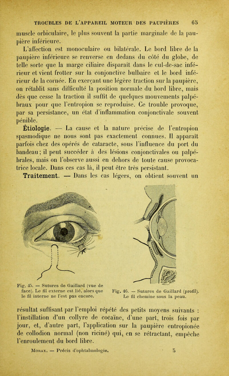 muscle orbiciilaire, le plus souvent la partie marginale de la pau- pière inférieure. L'affection est monoculaire ou bilatérale. Le bord libre de la paupière inférieure se renverse en dedans du côté du globe, de telle sorte que la marge ciliaire disparaît dans le cul-de-sac infé- rieur et vient frotter sur la conjonctive bulbaire et le bord infé- rieur de la cornée. En exerçant une légère traction sur la paupière, on rétablit sans difficulté la position normale du bord libre, mais dès que cesse la traction il suffit de quelques mouvements palpé- braux pour que Tentropion se reproduise. Ce trouble provoque, par sa persistance, un état d'inflammation conjonctivale souvent pénible. Étiologie. — La cause et la nature précise de Tentropion spasmodique ne nous sont pas exactement connues. Il apparaît parfois chez des opérés de cataracte, sous l'influence du port du bandeau ; il peut succéder à des lésions conjonctivales ou palpé- braies, mais on Fobserve aussi en dehors de toute cause provoca- trice locale. Dans ces cas là, il peut être très persistant. Traitement. — Dans les cas légers, on obtient souvent un face). Le fil externe est lié, alors que Fig, 46. — Sutures de Gaillard (profil), le fil interne ne l'est pas encore. Le fil chemine sous la peau. résultat suffisant par l'emploi répété des petits moyens suivants : l'instillation d'un collyre de cocaïne, d'une part, trois fois par jour, et, d'autre part, l'apphcation sur la paupière entropionée de collodion normal (non riciné) qui, en se rétractant, empêche Fenroulement du bord libre. MouAX. — Précis d'ophtalmologie.