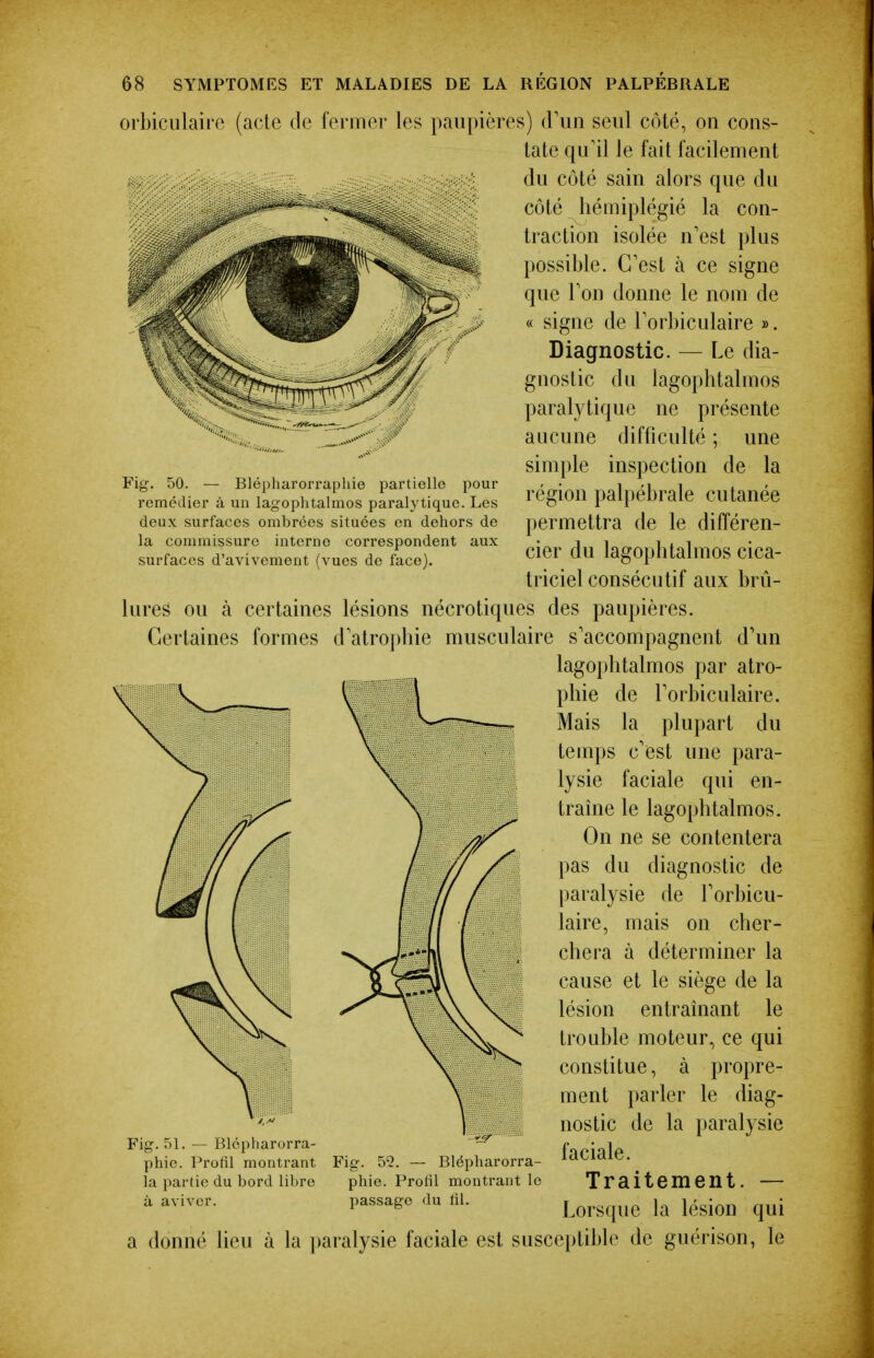 pour ig. 50. — Blépharorraphie partielle remédier à un lagophtalmos paralytique. Les deux surfaces ombrées situées en dehors de la commissure interne correspondent aux surfaces d'avivement (vues de face). orbiculaire (acte de fermer les paupières) (riiii seul côté, on cons- tate qu'il le fait facilement ;K du côté sain alors que du côté hémiplégié la con- traction isolée n'est plus possible. C'est à ce signe que Ton donne le nom de « signe de Torbiculaire ». Diagnostic. — Le dia- gnostic du lagophtalmos paralytique ne présente aucune difficulté ; une simple inspection de la région palpébrale cutanée permettra de le différen- cier du lagophtalmos cica- triciel consécutif aux brû- lures ou à certaines lésions nécrotiques des paupières. Certaines formes d atrophie musculaire s'accompagnent d'un lagophtalmos par atro- phie de l'orbiculaire. Mais la plupart du temps c'est une para- lysie faciale qui en- traine le lagophtalmos. On ne se contentera pas du diagnostic de paralysie de l'orbicu- laire, mais on cher- chera à déterminer la cause et le siège de la lésion entraînant le trouble moteur, ce qui constitue, à propre- ment parler le diag- nostic de la i»aralysie faciale. Traitement. — Lorsque la lésion qui ieu à la ])aralysie faciale est susceptible de guérison, le Fig. 51. — Blépharorra- phie. Profil montrant la partie du bord libre à aviver. a donné Fig. 5^2. — Blépharorra- phie. Profil montrant le passage du fil.