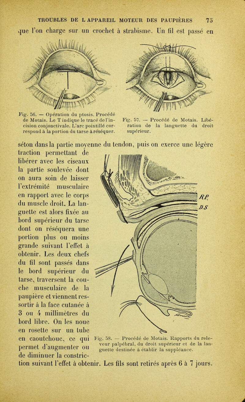 que Ton charge sur un crochet à strahisme. Un fil est passé en Fig. 56. — Opération du ptosis. Procédé de Motais. Le T indique le tracé de l'in- cision conjonctivale. L'arc pointillé cor- respond à la portion du tarse à réséquer. Fig. 57. — Procédé de Motais. Libé- ration de la languette du droit supérieur. séton dans la partie moyenne du tendon, puis on exerce une légère traction permettant de Hhérer avec les ciseaux la partie soulevée dont on aura soin de laisser l'extrémité musculaire en rapport avec le corps du muscle droit. La lan- guette est alors fixée au hord supérieur du tarse dont on réséquera une portion plus ou moins grande suivant Teffet à obtenir. Les deux chefs du fil sont passés dans le bord supérieur du tarse, traversent la cou- che musculaire de la paupière et viennent res- sortir à la face cutanée à 3 ou 4 milhmètres du bord libre. On les noue en rosette sur un tube en caoutchouc, ce qui permet d'augmenter ou de diminuer la constric- tion suivant Teffet à obtenir Fio-. 58 Procédé de Motais. Rapports du rele- veur palpébral, du droit supérieur et de la lan- guette destinée à établir la suppléance. Les fils sont retirés après 6 à 7 jours.