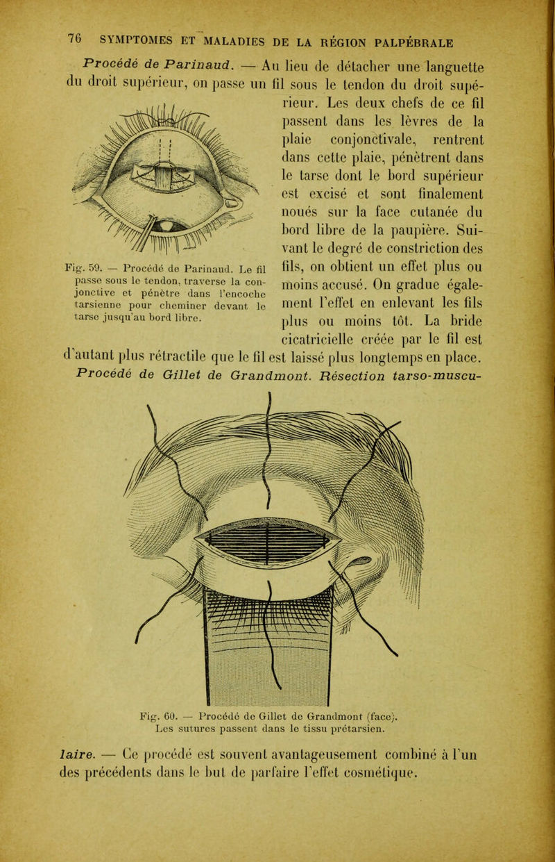 Procédé de Parinaud. — Au lieu de détacher uue languette du droit supérieur, on passe un fil sous le tendon du droit supé- rieur. Les deux chefs de ce fil passent dans les lèvres de la plaie conjonctivale, rentrent dans cette plaie, pénètrent dans le tarse dont le bord supérieur est excisé et sont finalement noués sur la face cutanée du bord libre de la paupière. Sui- vant le degré de constriction des fils, on obtient un effet plus ou moins accusé. On gradue égale- ment Feffet en enlevant les fils plus ou moins tôt. La bride cicatricielle créée par le fil est d autant })lus rétractile que le fil est laissé plus longtemps en place. Procédé de Gillet de Grandmont. Résection tarso-muscu- Fig. 59. — Procédé de Parinaud. Le fil passe sous le tendon, traverse la con- jonctive et pénètre dans l'encoche tarsienne pour cheminer devant le tarse jusqu'au bord libre. Fig. 60. — Procédé do Gillct do Grandmont (face). Les sutures passent dans le tissu prétarsien. laire. — Ce procédé est souvent avantageusement combiné à Tun des précédents dans le but de parfaire Teffet cosmétique.