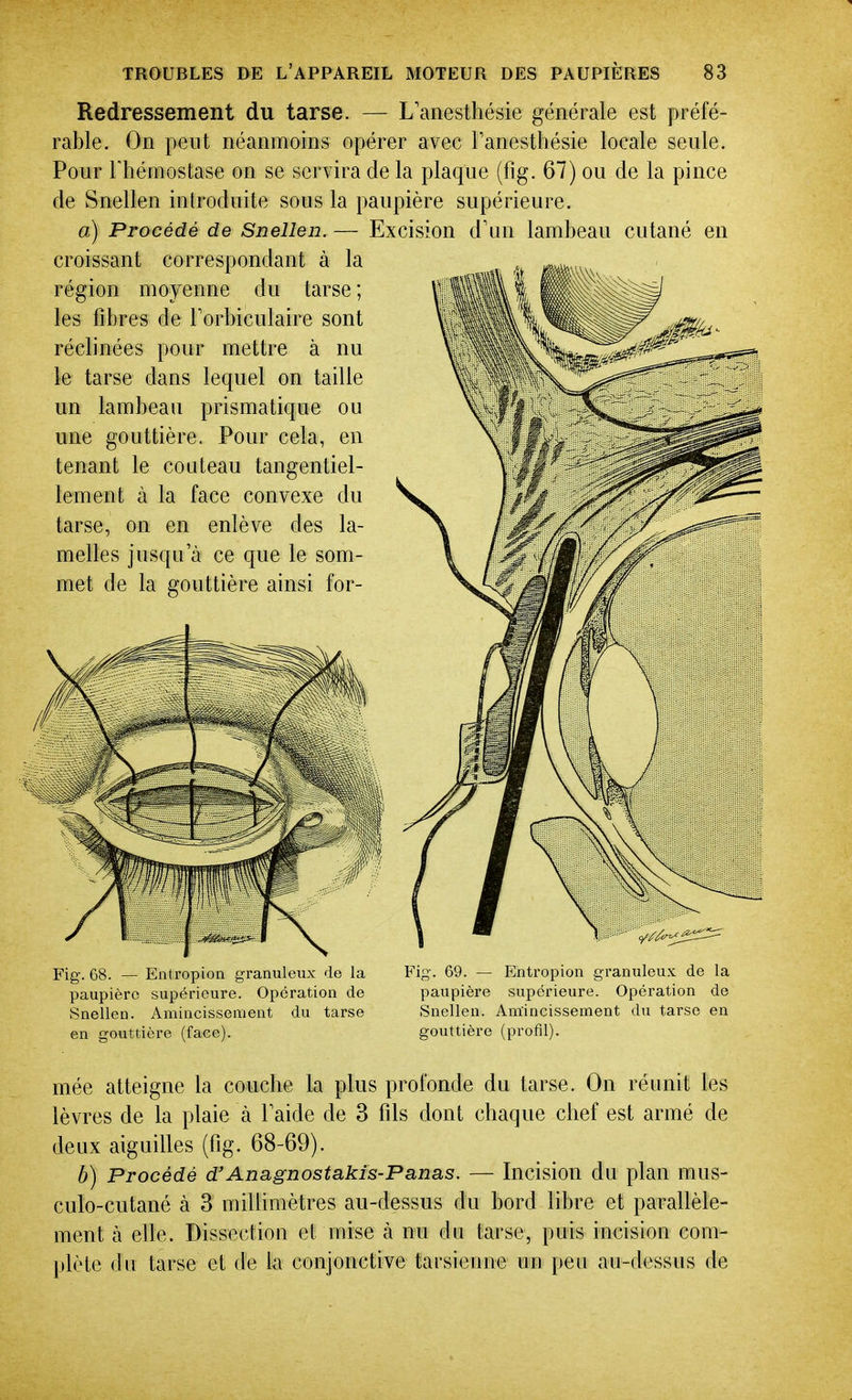 Redressement du tarse. — L'anesthésie générale est préfé- rable. On peut néanmoins opérer avec Tanesthésie locale seule. Pour rhémostase on se servira de la plaque (fig. 67) ou de la pince de Snellen introduite sous la paupière supérieure. a) Procédé de Snellen. — Excision d'un lambeau cutané en croissant correspondant à la région moyenne du tarse; les fibres de Torbiculaire sont réclinées pour mettre à nu le tarse dans lequel on taille un lambeau prismatique ou une gouttière. Pour cela, en tenant le couteau tangentiel- lement à la face convexe du tarse, on en enlève des la- melles jusqu'à ce que le som- met de la gouttière ainsi for- Fig. 68. — Eiitropion granuleux de la paupière supérieure. Opération de Snellen. Amincissenient du tarse en gouttière (faee). Fig-. 69. — Entropion granuleux de la paupière supérieure. Opération de Snellen. Amincissement du tarse en gouttière (profil). mée atteigne la couche la plus profonde du tarse. On réunit les lèvres de la plaie à Taide de 3 fds dont chaque chef est armé de deux aiguilles (fig. 68-69). b) Procédé d'Anagnostakis-Panas. — Incision du plan mus- culo-cutané à 3 millimètres au-dessus du bord libre et parallèle- ment à elle. Dissection et mise k nu du tarse, puis incision com- l)lète du tarse et de la conjonctive tarsienne un peu au-dessus de