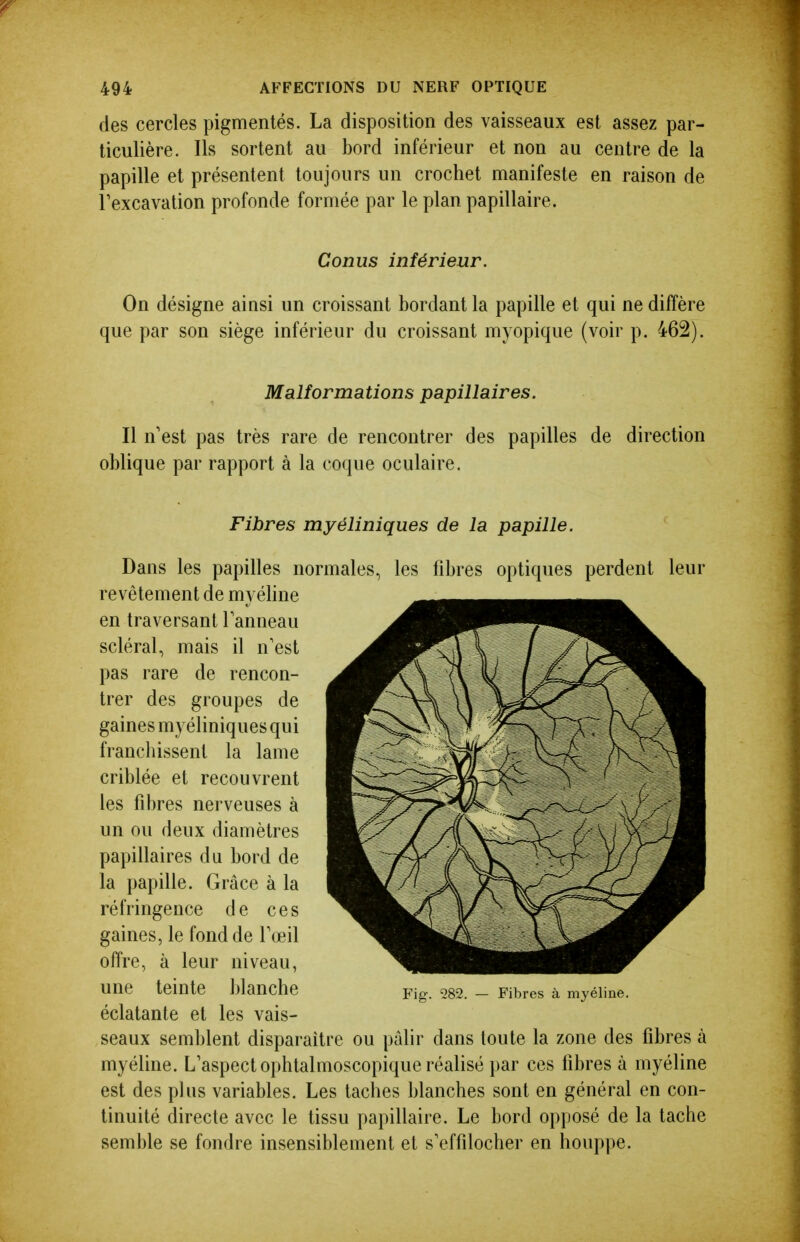 des cercles pigmentés. La disposition des vaisseaux est assez par- ticulière. Ils sortent au bord inférieur et non au centre de la papille et présentent toujours un crochet manifeste en raison de l'excavation profonde formée par le plan papillaire. Conus inférieur. On désigne ainsi un croissant bordant la papille et qui ne diffère que par son siège inférieur du croissant myopique (voir p. 462). Malformations papillaires. Il n'est pas très rare de rencontrer des papilles de direction oblique par rapport à la coque oculaire. Fibres myéliniques de la papille. Dans les papilles normales, les fibres optiques perdent leur revêtement de myéline en traversantlanneau scierai, mais il n'est pas rare de rencon- trer des groupes de gaines myéliniques qui franchissent la lame criblée et recouvrent les fibres nerveuses à un ou deux diamètres papillaires du bord de la papille. Grâce à la réfringence de ces gaines, le fond de l'œil offre, à leur niveau, une teinte blanche pig. 282. - Fibres à myéline. éclatante et les vais- seaux semblent disparaître ou pâlir dans toute la zone des fibres à myéline. L'aspect ophtalmoscopique réalisé par ces libres à myéline est des plus variables. Les taches blanches sont en général en con- tinuité directe avec le tissu papillaire. Le bord opposé de la tache semble se fondre insensiblement et s'effilocher en houppe.