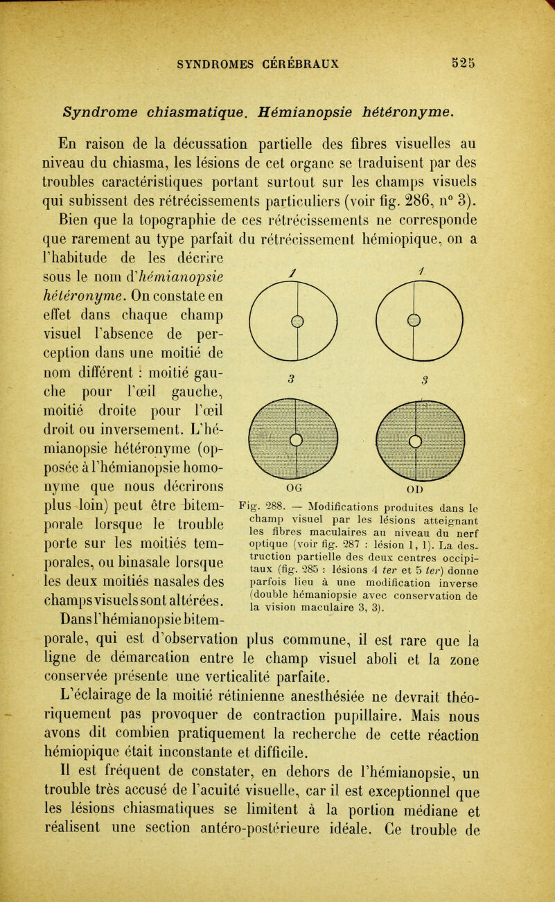 Syndrome chiasmatique. Hémianopsie hétéronyme. En raison de la décussation partielle des fibres visuelles au niveau du chiasma, les lésions de cet organe se traduisent par des troubles caractéristiques portant surtout sur les champs visuels qui subissent des rétrécissements particuliers (voir fig. 286, n° 3). Bien que la topographie de ces rétrécissements ne corresponde que rarement au type parfait du rétrécissement hémiopique, on a riiabitude de les décnre sous le nom d'hémianopsie hétéronyme. On constate en effet dans chaque champ visuel Tabsence de per- ception dans une moitié de nom différent : moitié gau- che pour rœil gauche, moitié droite pour Tœil droit ou inversement. L'hé- mianopsie hétéronyme (op- posée à rhémianopsie homo- nyme que nous décrirons plus loin) peut être bitem- porale lorsque le trouble porte sur les moitiés tem- porales, ou binasale lorsque les deux moitiés nasales des champs visuels sont altérées. Dans rhémianopsie bitem- porale, qui est d'observation plus commune, il est rare que la ligne de démarcation entre le champ visuel aboli et la zone conservée présente une verticalité parfaite. L'éclairage de la moitié rétinienne anesthésiée ne devrait théo- riquement pas provoquer de contraction pupillaire. Mais nous avons dit combien pratiquement la recherche de cette réaction hémiopique était inconstante et difficile. Il est fréquent de constater, en dehors de rhémianopsie, un trouble très accusé de facuité visuelle, car il est exceptionnel que les lésions chiasmatiques se limitent à la portion médiane et réalisent une section antéro-postérieure idéale. Ce trouble de 3 3 OG OD Fig. 288. — Modifications produites dans le champ visuel par les lésions atteignant les fibres maculaires au niveau du nerf optique (voir fig. 287 : lésion 1, 1). La des- truction partielle des deux centres occipi- taux (fig. 285 : lésions 4 ter et 5 ter) donne parfois lieu à une modification inverse (double hémaniopsie avec conservation de la vision maculaire 3, 3).