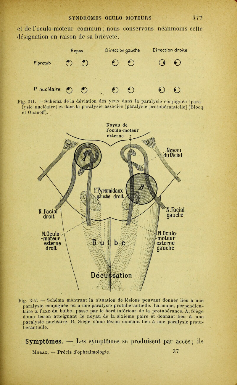 et de rociilo-moteiir commun ; nous conservons néanmoins cette désignation en raison de sa brièveté. Repos Direction gauche Direction droite Rprotub © © O O O O P nucléaire Ç) (J) , O O O O Fig. 311. — Schéma delà déviation des yeux dans la paralysie conjuguée [para- lysie nucléaire] et dans la paralysie associée [paralysie protubéranticlle] (Blocq et Onanoff). Noyau de Fig. 312. — Schéma montrant la situation de lésions pouvant donner lieu à une paralysie conjuguée ou à une paral3'sie protubérantielle. La coupe, perpendicu- laire à l'axe du bulbe, passe par le bord inférieur de la protubérance. A, Siège d'une lésion atteignant le noyau de la sixième paire et donnant lieu à une paralysie nucléaire. B, Siège d'une lésion donnant lieu à une paralysie protu- bérantielle. Symptômes. — Les symptômes se produisent par accès; ils MoRAx. — Précis d'ophtalmologie. 37