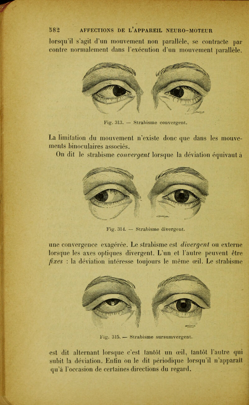 lorsqu'il s'agit d'un mouvement non parallèle, se contracte par contre normalement dans Texécution d'un mouvement parallèle. Fig. 313. — Strabisme convergent. La limitation du mouvement n'existe donc que dans les mouve- ments binoculaires associés. On dit le strabisme convergent lorsque la déviation équivaut à Fig. 314. — Strabisme divergent. une convergence exagérée. Le strabisme est divergent ou externe lorsque les axes opti({ues divergent. L'un et l'autre peuvent être fixes : la déviation intéresse toujours le même œil. Le strabisme Fig. 315. — Strabisme sursumvergent. est dit alternant lorsque c'est tantôt un œil, tantôt l'autre qui subit la déviation. Enfin on le dit périodi(iue lorsqu'il n'apparaît (ju'à l'occasion de certaines directions du regard.